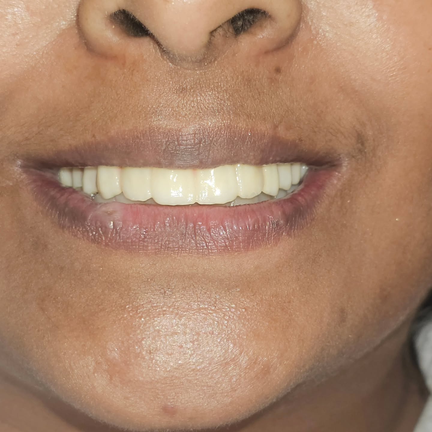 Full arch reconstruction using All on 6 protocol along with root submerging to protect bone from accelerated resorption. Prosthesis done using Zirconia and titanium hybrid.
Precise, Pleasant and Aesthetic Digital Dentistry
#allon6 #zirconia #neodent #fullmouthrehabilitation #implantdentistry