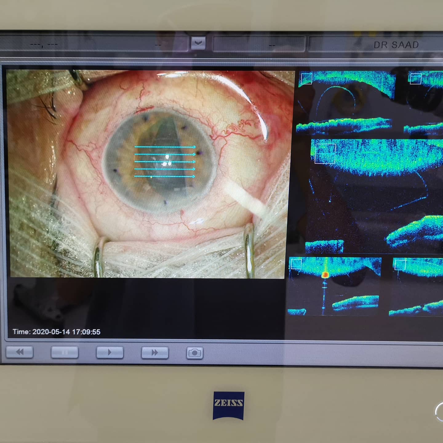 Back on track #firstdmekaftercovid #dmek #keratoplasty #feelsgood