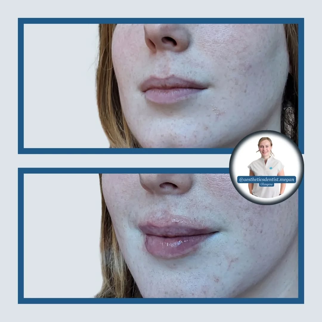 A combination lip case:
(SWIPE through 👉)
For this gorgeous patient we first relaxed the strong lip muscle to stop it from curling under when smiling
Then we introduced some soft filler to add some extra definition & volume to an already lovely shaped pout 👍
Natural from all angles, we create lips that act like lips 💋 😘
No more lipstick transferring onto the teeth, and lips that now frame the smile perfectly by minimising the amount of gum on show
You can book yours at the link in bio when you're ready
Megan x
Using 0.7ml @teoxaneofficial RHA kiss