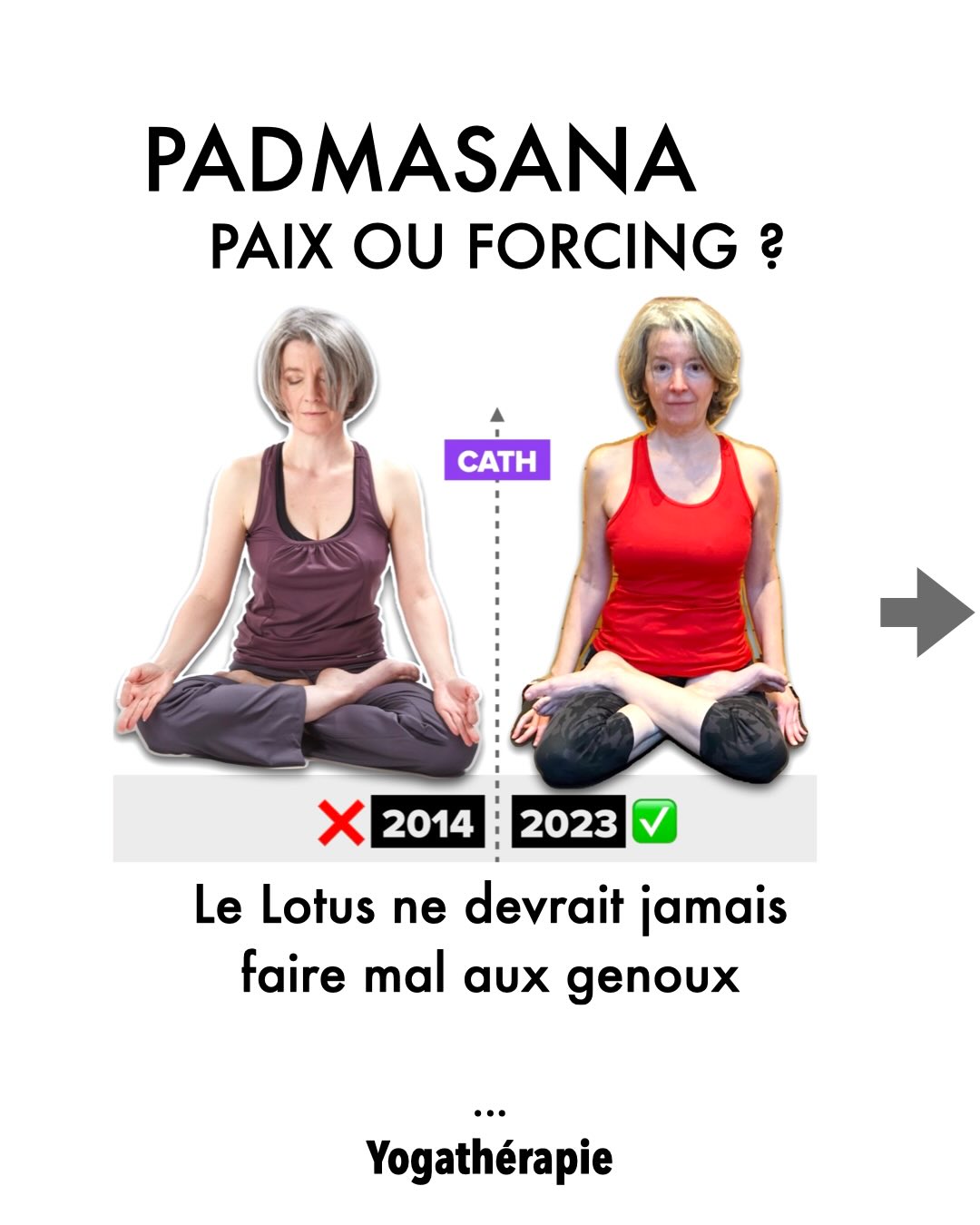 LE LOTUS : ARCHITECTURE SACRÉE OU DANGER MÉCANIQUE ? 💎❌
Le Lotus 🪷 ne devrait jamais être une épreuve de force 💥
C’est une question d’architecture. 💎
Pendant des années, j’ai cru que mes genoux étaient « fragiles ». En réalité, je les utilisais comme des fusibles pour compenser un bassin verrouillé en rétroversion.
En 2014, je forçais.
Je pensais faire du Yoga alors que je mettais mon système sous scellés.
Le résultat ? Des chevilles en entorse et des ménisques en sursis.
Pourquoi vos genoux sont-il sensibles ?
🦴 Le genou est une articulation intermédiaire. Il ne possède aucune défense face à une hanche qui refuse de s’ouvrir. (Loi de Hilton)
Forcer, c’est entrer en guerre contre sa propre neurologie.
La solution n’est pas dans la souplesse, elle est dans l’aplomb.
En 2023, l’antéversion du bassin a tout changé. Ce n’est pas mon corps qui est devenu plus souple, c’est ma structure qui est devenue plus intelligente.
Récupérer l’alignement, c’est enfin autoriser le corps à se déposer. Dans la paix, pas dans la lutte.
⚡️ ENVIE D’ARRÊTER LE FORCING ?
Nous avons rédigé un dossier complet sur Padmasana pour vous aider à transformer votre assise.
👉 Commentez « LOTUS » ci-dessous et je vous envoie le lien en privé !
#Lotus #YogaTherapie #Padmasana #YogaAnatomy #cathetsergeyoga
