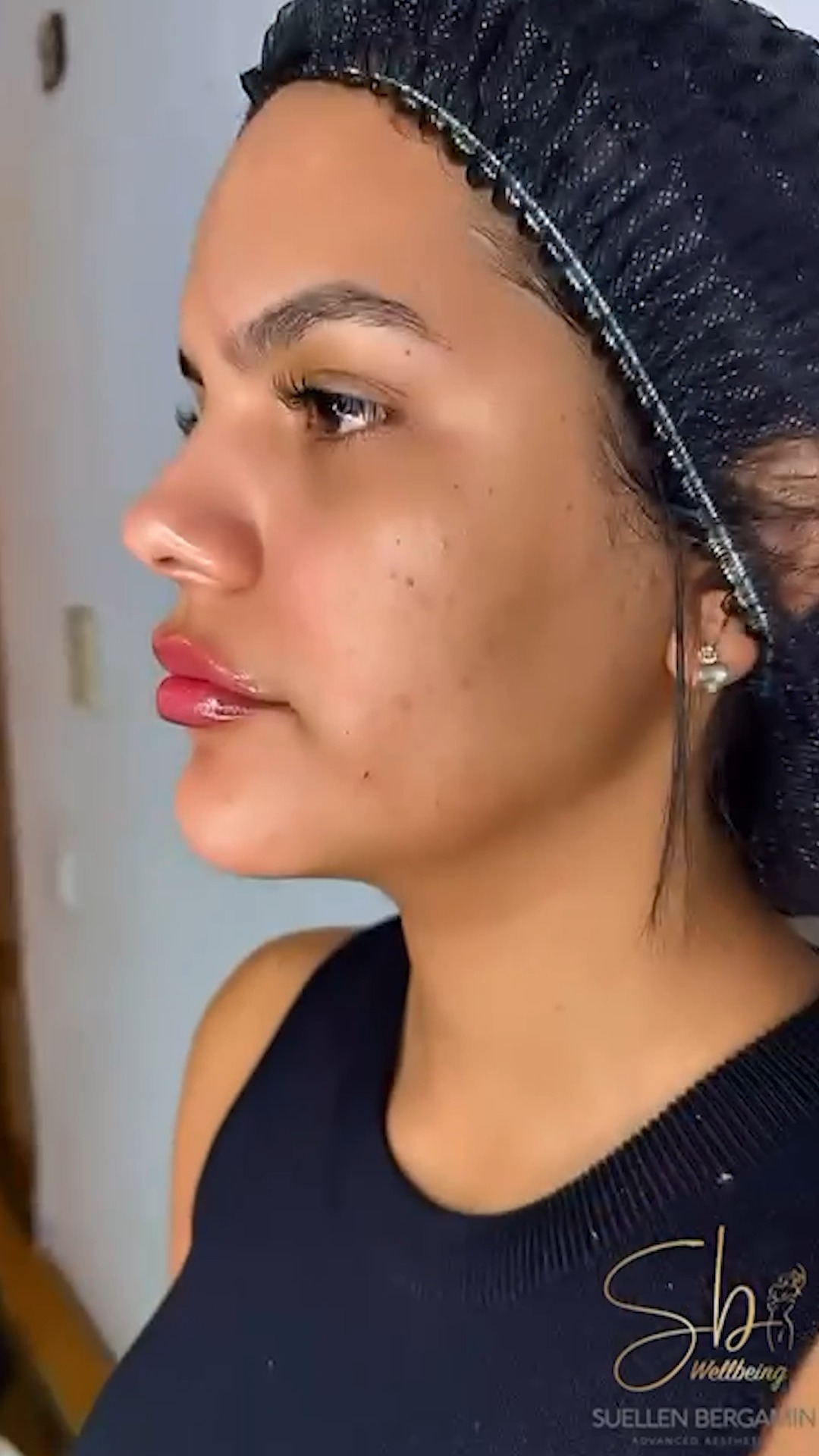 Você já percebeu como pequenos ajustes podem mudar completamente a harmonia do rosto?
A perfiloplastia é um conjunto de procedimentos (como preenchimento de queixo, mandíbula e, em alguns casos, nariz) que tem como objetivo equilibrar o perfil facial, valorizando seus traços naturais.
O foco não é mudar quem você é.
É realçar o que você já tem de mais bonito!
O resultado? Um rosto mais harmônico, elegante e proporcional, sem perder a naturalidade.
Agende sua avaliação e vamos juntas realçar a sua beleza!
📲+44 7398 192413
.
Have you ever noticed how small adjustments can completely transform the harmony of your face?
Profile harmonization (profileplasty) is a combination of procedures (such as chin, jawline, and in some cases, nose fillers) designed to balance the facial profile while enhancing your natural features.
The goal is not to change who you are.
It’s to highlight the most beautiful features you already have!
The result? A more harmonious, elegant, and proportionate face — without losing your natural look.
Book your consultation and let’s enhance your beauty together!
📲 +44 7398 192413