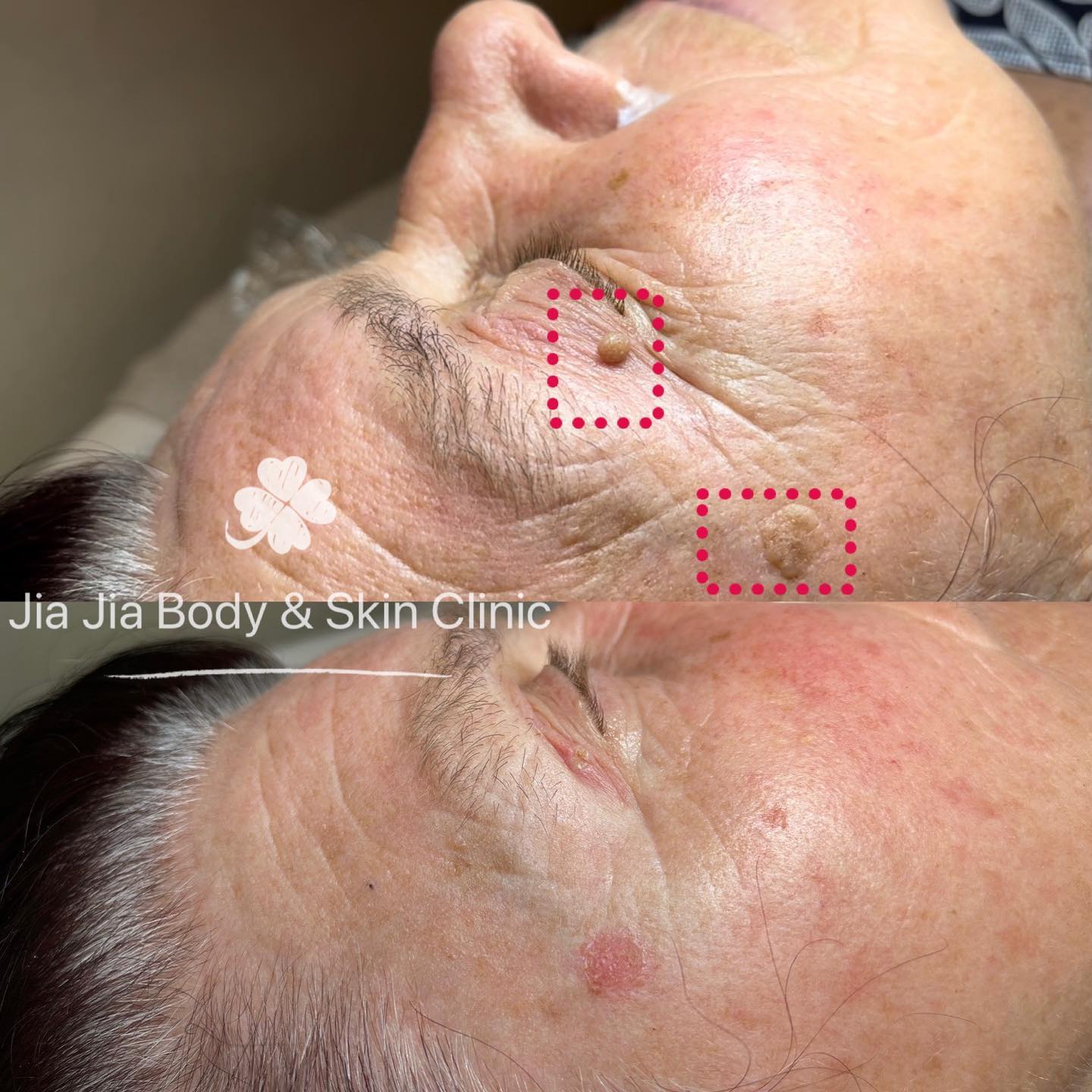 SKIN TAG REMOVED IN 2 SECONDS, like literally!!
The removal was so fast and easy we circled the area in case you didn't see it 😏
Come in to get a consultation or just make a booking to remove it, easy-peasy.
#skintagremoval #skintags #clearskin
#jiajiabodyandskinclinic
#toprydecity #rydebeautysalon
#pigmentationtreatment #laserremoval #skintagremoval