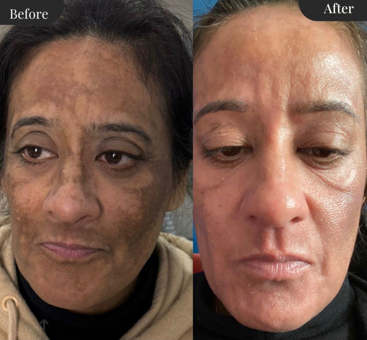 ✨ Pigmentation Treatment: Obagi Nu-Derm®️ Under Expert Nurse-Led Care ✨
*not our work*
Pigmentation isn’t just a cosmetic concern — it’s a chronic skin disorder. That means it doesn’t have a “quick fix”, but with the right guidance and medical-grade treatment, it can be beautifully controlled.
🧴 Obagi Medical Nu-Derm®️ is widely recognised as the gold standard prescription system for pigmentation, melasma, and uneven skin tone. It works by correcting pigment formation at a cellular level and transforming overall skin health — not just lightening dark patches.
👩⚕️ Why nurse-led care matters:
Obagi Nu-Derm®️ is powerful and must be used correctly and safely. Under expert nurse prescriber supervision, your skin is carefully prepared, monitored, and supported to maximise results while protecting the skin barrier.
✨ What we educate every patient on:
✔ Pigmentation requires lifelong management, not one-off treatment
✔ Consistency, sun protection, and maintenance are key
✔ Prescription treatments must be tailored — never generic
✔ Results can be exceptional with the right plan and professional guidance
When used under expert nurse-led care, Obagi Nu-Derm®️ can deliver transformative, long-term improvement in pigmentation, clarity, and skin confidence.
📍 Nurse prescriber–led clinic
📩 DM us to start your personalised pigmentation programme