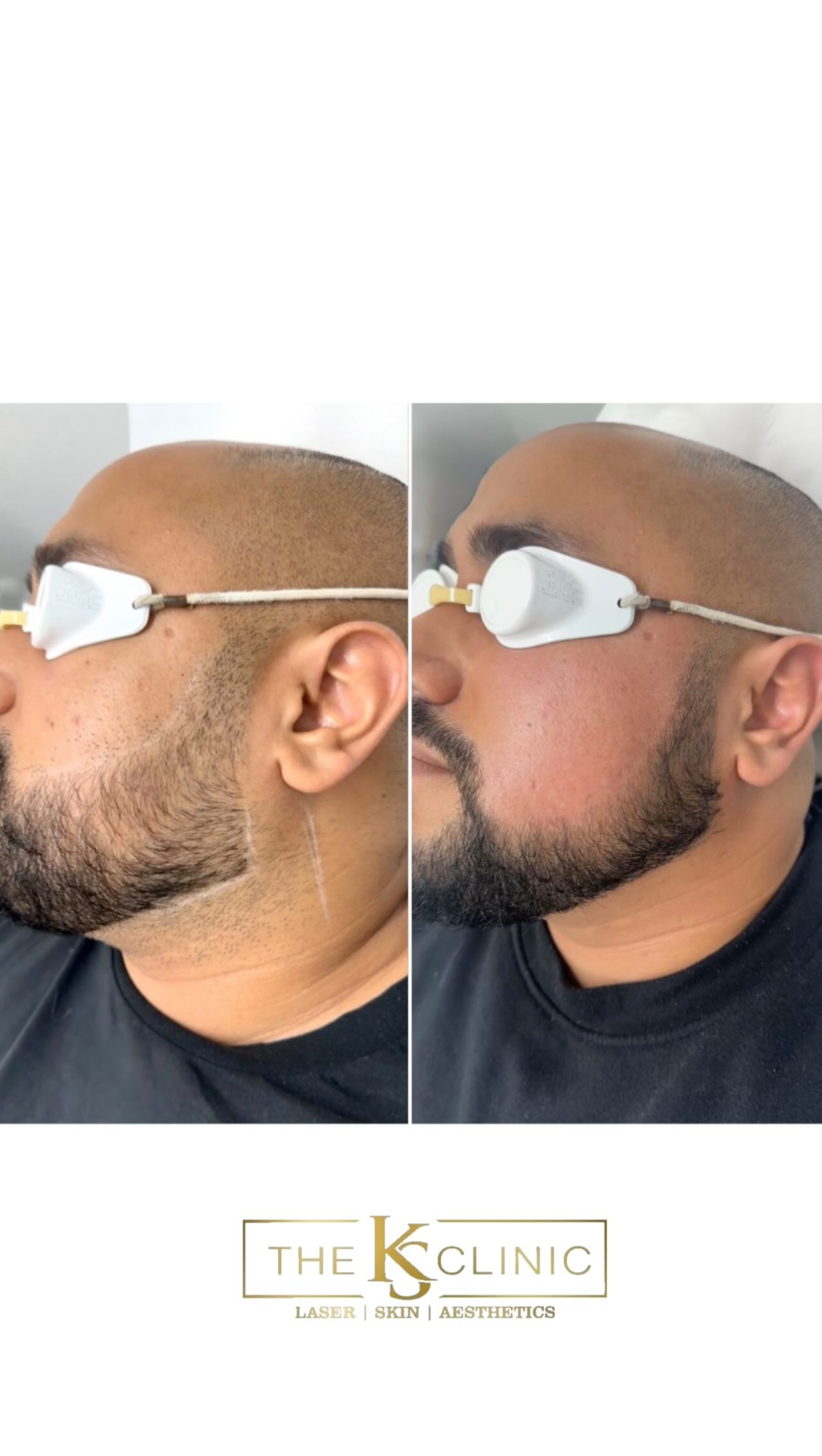 MALE GROOMING, UPGRADED!
Laser hair removal results you can see-with a plan that protects skin of colour.
In just 1-5 sessions our client keeps his beard, but without the hassle.
For a clean sharp finish all year round.
Book with us today, link in bio.
@theksclinic #barberlife #laserhairremoval #laserclinic #malegrooming #birmingham