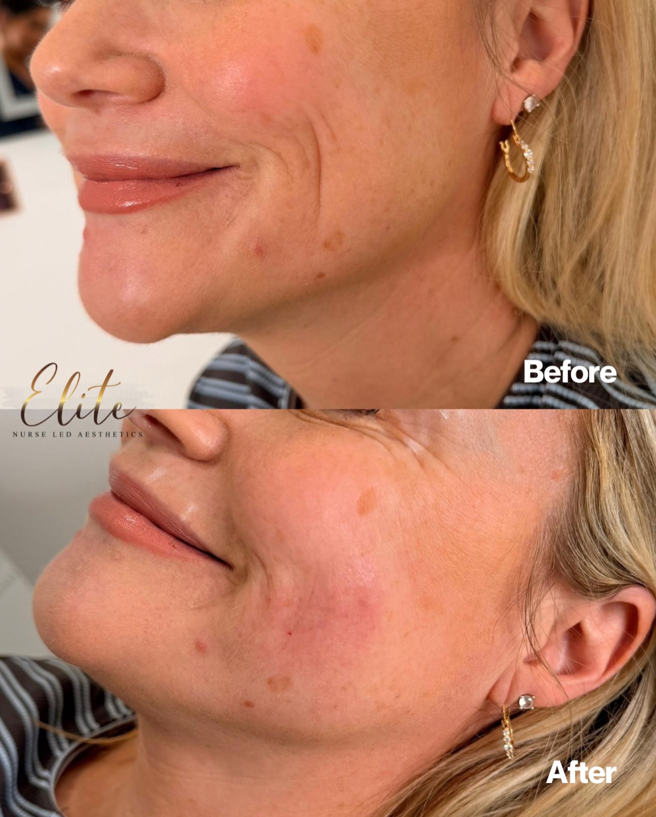 ✨ Accordion Lines: Softened, Smoothed, Refreshed ✨
Accordion lines – those fine, crinkly lines that appear around the mouth when you smile or move – can be one of the trickiest areas to treat. The secret? Combination therapy.
💉 Dermal Filler works by restoring lost volume and supporting the skin from within, gently smoothing creases without heaviness or stiffness.
🔥 CO₂ Laser targets the skin’s surface, stimulating collagen, tightening lax skin, and improving texture at a deeper level.
💎 Why this combination is the gold standard:
✔ Treats both volume loss AND skin quality
✔ Creates a smoother, more natural result
✔ Improves fine lines, creasing, and overall skin strength
✔ Results continue to improve as collagen rebuilds
Instead of masking the problem, we treat the cause – ageing skin that needs support and stimulation. The result? A softer smile, healthier skin, and beautifully natural rejuvenation.