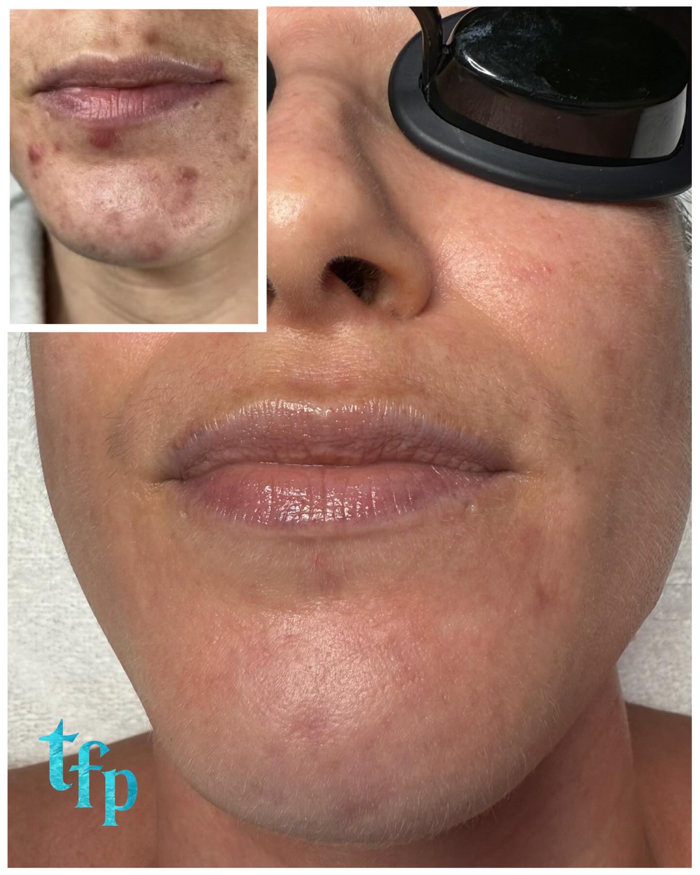 Acne Bootcamp Before + After 🩵 We are both loving these results!
Clearing your acne naturally is possible with my biweekly Acne Bootcamp program. You can get clear skin in 3-5 months 🩵
How it works:
🪼Come in biweekly for acne facials (discounted to $109)
🪼Purchase a full customized skincare routine with me and do it morning and night at home (around $300 give or take)
🪼Switch to acne-safe makeup and laundry detergent
🪼Minimize acne triggering foods in your diet
I am taking new bootcamp clients so lets get you clear once and for all! Book on thefaceplacemi.com ! I can’t wait to help you🌊🫶🏼
