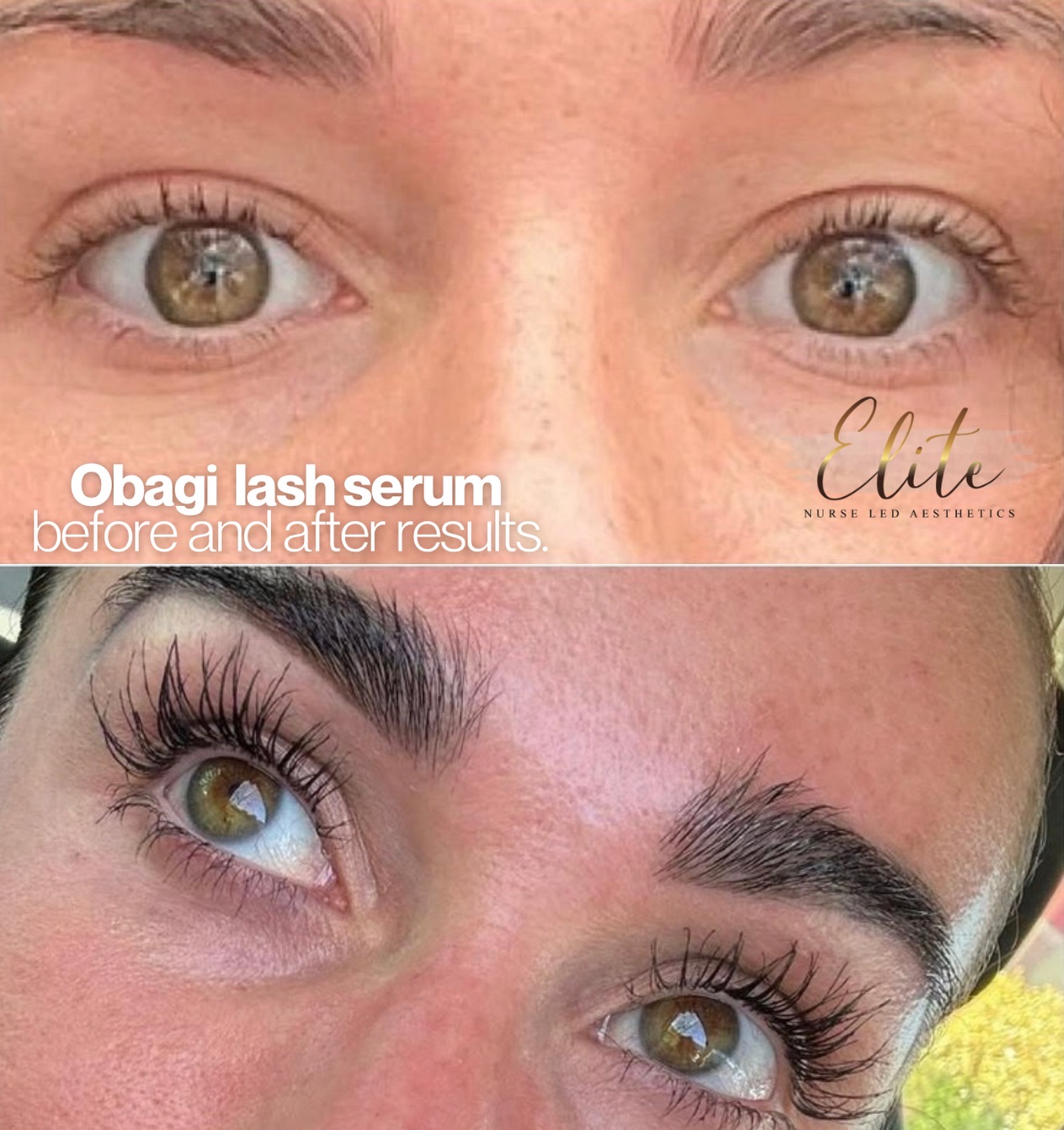 👁️ Real lashes. Real results. 👁️
This is the power of Obagi NU-Cil® Lash Serum — proven growth you can actually see.
✨ Before & after results speak for themselves
With consistent use, this advanced serum helps transform short, sparse lashes into lashes that look longer, fuller, and healthier.
💎 Benefits of Obagi NU-Cil® Lash Serum:
✔ Promotes longer, thicker-looking lashes
✔ Improves lash density and strength
✔ Nourishes and conditions the lash line
✔ Helps reduce breakage and shedding
✔ Enhances natural lashes without extensions
Perfect if you want naturally beautiful lashes — no falsies, no maintenance.
📍 Elite Nurse Led Aesthetics – Wakefield
💬 Ready to upgrade your natural lashes?
Pop us a message or book a consultation to get started ✨
#EliteNurseLedAesthetics #WakefieldAesthetics #ObagiNUCil #LashGrowthSerum #NaturalLashes