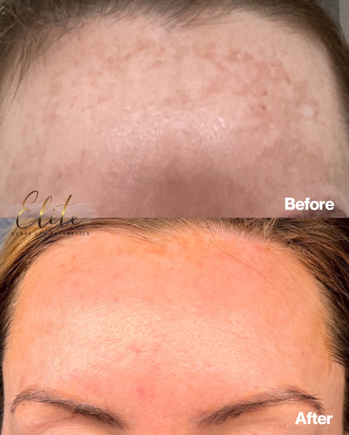 ✨ Say goodbye to stubborn pigmentation ✨
This is the power of CO₂ treatment — targeted, effective, and results-driven.
If you’ve tried everything and pigment still won’t budge, CO₂ therapy works by increasing oxygenation and circulation in the skin, helping to break down excess melanin, brighten the complexion, and restore clarity from within.
💎 What CO₂ treatment does for your skin:
✔ Reduces pigmentation & uneven tone
✔ Boosts oxygen and blood flow
✔ Supports skin repair & renewal
✔ Improves overall brightness
✔ Leaves skin clearer, fresher, and healthier
The result? A visibly brighter, more even complexion — just like this transformation.
📍 Elite Nurse Led Aesthetics – Wakefield
💬 Ready to say goodbye to pigment for good?
Book your consultation today and let’s create your glow ✨
#EliteNurseLedAesthetics #WakefieldAesthetics #PigmentationTreatment #CO2Facial #SkinResults