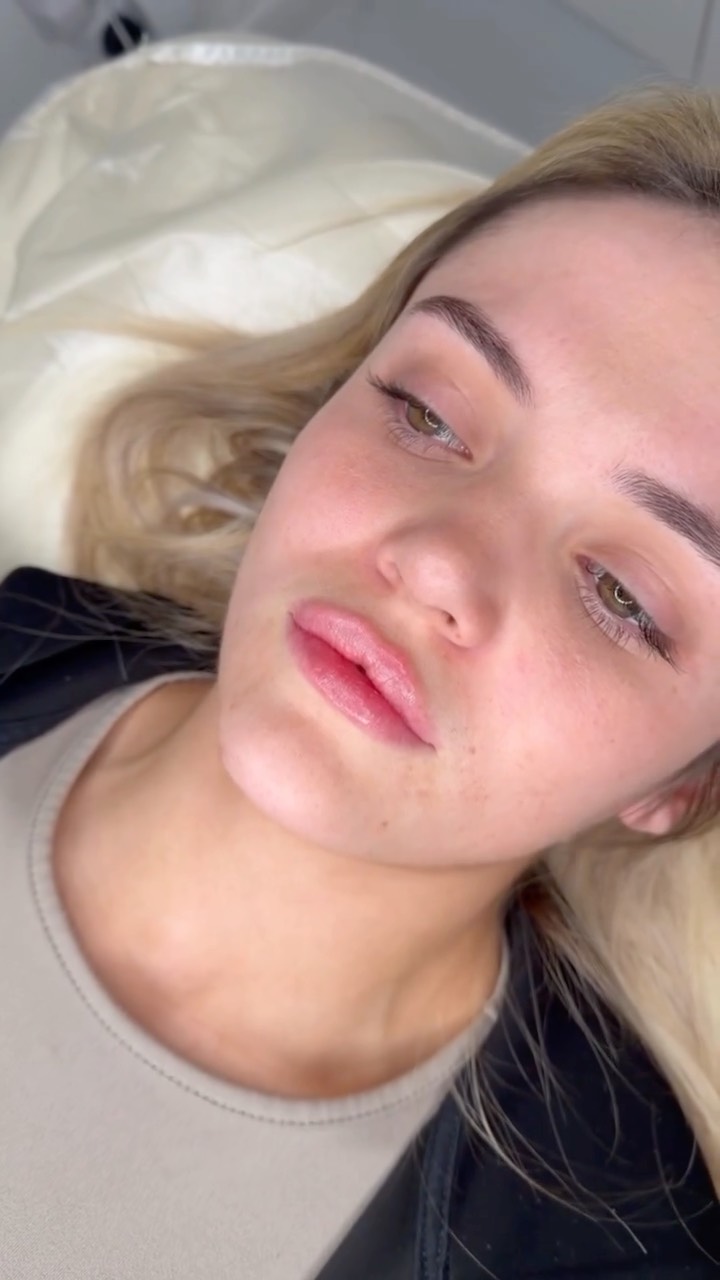 First time lips… but make them naturally stunning 💋
Curious about Russian lips but want to keep things soft, balanced, and you? This technique is perfect for first-timers who want shape without heaviness.
✨ What natural Russian lips do:
✔ Enhance lip shape & definition
✔ Create a lifted, heart-shaped appearance
✔ Add subtle volume without migration
✔ Improve symmetry
✔ Keep results natural and elegant
Using precise vertical placement, Russian lips focus on height and structure — not overfilling — giving you beautifully contoured lips that still feel like your lips.
📍 Elite Nurse Led Aesthetics – Wakefield
💉 Thinking about your first lip enhancement?
Book a consultation today and let’s create your perfect natural pout 💕
#EliteNurseLedAesthetics #WakefieldLips #RussianLipsUK #NaturalLipEnhancement #LipConfidence