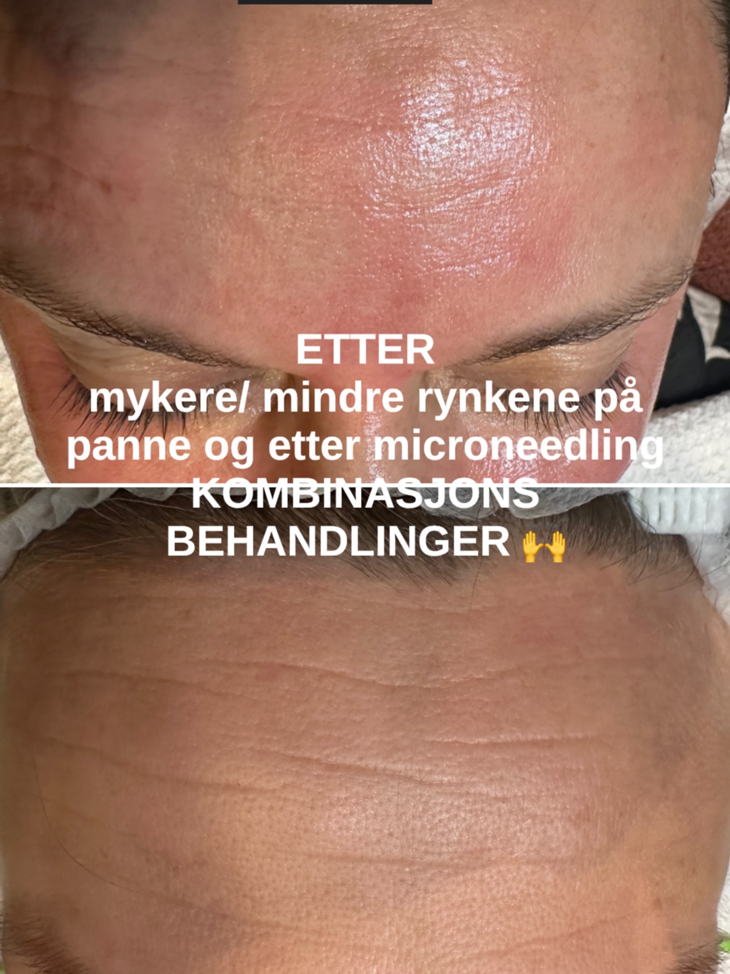✨ Signaturbehandling – resultat gjennom kompetanse
✨ – presisjon, erfaring og naturlige resultater
Kombinasjons ansiktsbehandling som inkluderer blant annet Microneedling, dermaplaning, radio frekvens, etc, er i seg selv kun verktøy.
Det er ekspertise/kompetanse, vurderingen og den presise utførelsen som avgjør resultatet.
Hos oss tilpasses behandlingen individuelt – basert på hudens tilstand, behov og lang klinisk erfaring. Dette krever kunnskap om hudens struktur, dybdevalg, teknikk og hvilke aktive ingrediener som faktisk vil gi ønsket effekt.
I tillegg til selve behandlingen tilfører vi nøye utvalgte vitaminer og aktive ingredienser – ikke kun hyaluronsyre – for å støtte hudens regenerering, styrke hudbarrieren og optimalisere kollagenstimuleringen.
Resultatet i pannen viser:
▫️ Mykere og glattere hud
▫️ Mindre fremtredende linjer
▫️ Jevnere hudstruktur
▫️ Økt spenst og glød
Vi jobber målrettet, men kontrollert – for å stimulere hudens egen kollagen- og elastinproduksjon uten å overbehandle.
Riktig dybde, riktig teknikk og riktige aktive ingredienser er avgjørende for et trygt og effektivt resultat.
Resultatene skapes av vår kliniske kompetanse, vurderingsevnen, presise utførelsen bak og spesialiserte ekspertise innen hudfornyelse på en naturlig måte, uten å involvere
Dette er ikke uten grunn vår mest populære ansiktsbehandling – og nå vår nye signaturbehandling Lillehammer Spa 🤍
👉https://www.lillehammerspa.no/service-page/fb-tilbud-microneedling-med-dermaplaning
#lillehammerspa @followers #followers #microneddling
Før og etter bilder er resultat etter 1 behandling