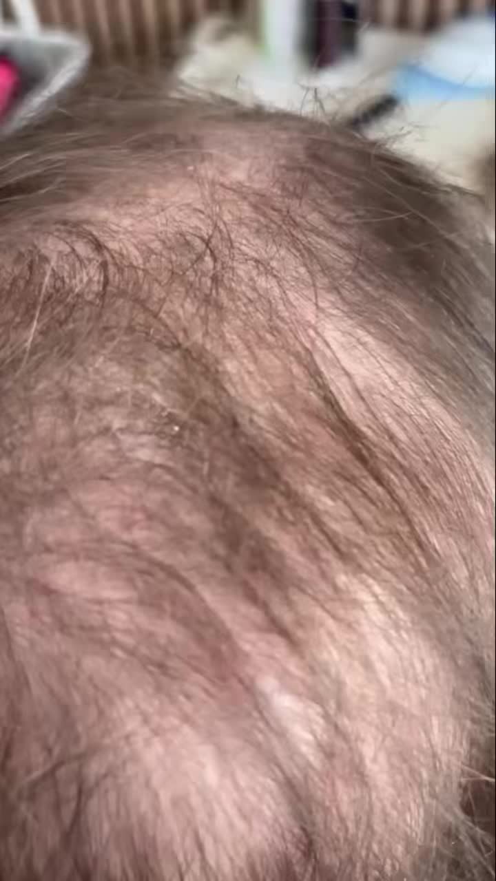 Hair loss doesn’t mean you have to settle.
There are real, medical-grade solutions available in the West of Ireland.
At Color Couture Limerick, we offer:
• Premium wigs
• Custom toppers
• Mesh integration
• CRLAB CNC prosthetic systems
Every case is different.
Every result is personalised.
Every client is guided properly.
We are proud to work with CRLAB, leaders in advanced hair restoration technology.
If you’re ready to explore your options, book a private consultation via the link in bio.
Discreet. Professional. Tailored.
#CRLabIreland #HairLossClinic #LimerickBusiness #CNCProsthetic #HairConfidence #WigsIreland