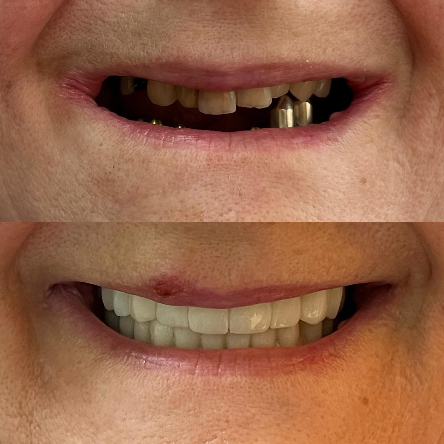 Üst çenede zirkonyum veneerler ile alt çenede ise 6 adet implant üzeri porselen kronlar ile hastamıza yeni bir gülüş kazandırdık.
.
.
.
*Bu paylaşım sağlık hizmetlerindeki bilgiyi ve farkındalığı arttırmak amacıyla hazırlanmış olup, reklam ve rekabet amacı içermez.
*Her cerrahi veya girişimsel işlemde sonuçlar kişiden kişiye değişiklik gösterebilir. İşlem öncesinde hekiminizden detaylı görüş almanız önerilir.
