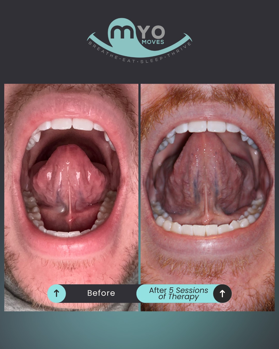 Tongue posture isn’t just a “nice-to-have”.... it’s a major player in how you breathe, sleep, and feel every day.
This patient came to us with low tongue posture and difficulty maintaining a proper seal. After just 5 sessions of targeted myofunctional therapy, their tongue mobility, elevation, and suction strength have made incredible progress.
✨ What you’re seeing:
• Higher tongue lift
• Stronger suction
• More stability + control
• A healthier foundation for breathing + sleep
Your tongue is a muscle, and muscles can be trained!
If you’re curious what your own before + after could look like, schedule a consultation with us today!
#beforeandafter #airwayhealth #myofunctionaltherapy #myo #breathebetter