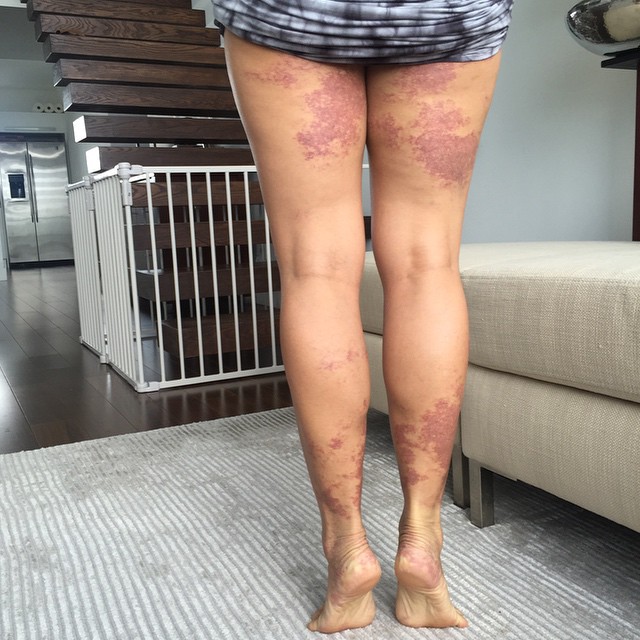 Ok so today is pulse dye laser treatment number two for 2014 but only doing my legs today. I will be doing both legs and face in mid December #portwinestain #sturgewebersyndrome #birthmark #pulsedyelaser #pws #sws #prettyinpink