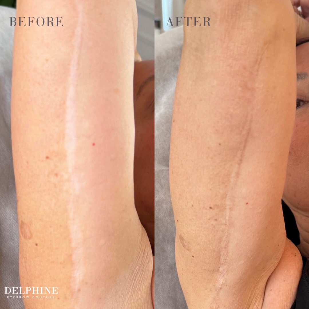 Your scars tell a story, but they should not dictate how you feel in your own skin.
Scar restoration through micropigmentation is a highly specialized technique designed to blend and visually minimize scars caused by surgery, trauma, or life’s unexpected moments.
My approach is conservative and natural, always with a light touch and deep intention.
This is not about perfection.
It’s about restoration.
It’s about feeling whole again.
Healing begins when you are seen, heard, and restored.
Trusted by surgeons and dermatologists in NYC.
Learn more: https://www.delphineeyebrowcouture.com/scarrepairthrough
#ScarRestoration #BeautyRestoration #ScarCamouflage #PMU #SemiPermanentMakeup