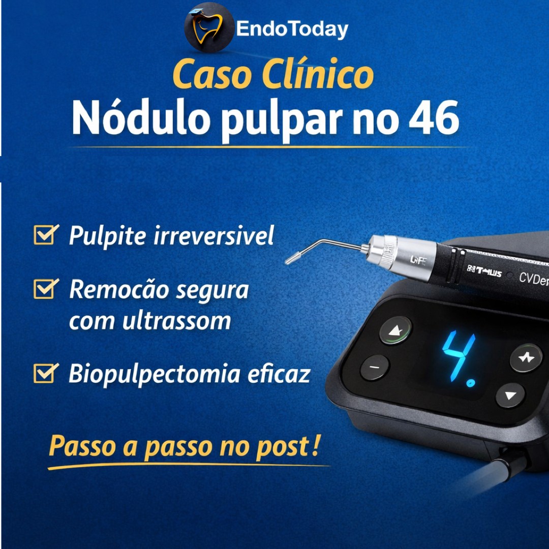 Biopulpectomia no 46 com nódulo pulpar — acesso ultrassônico seguro. Caso clínico passo a passo para evitar perfuração e otimizar resultados. Link in Bio #endodontia #endotoday #dentistaendodontista #tratamentodecanal #endodontiaavançada #microscopiaendodôntica #clínicadeendodontia