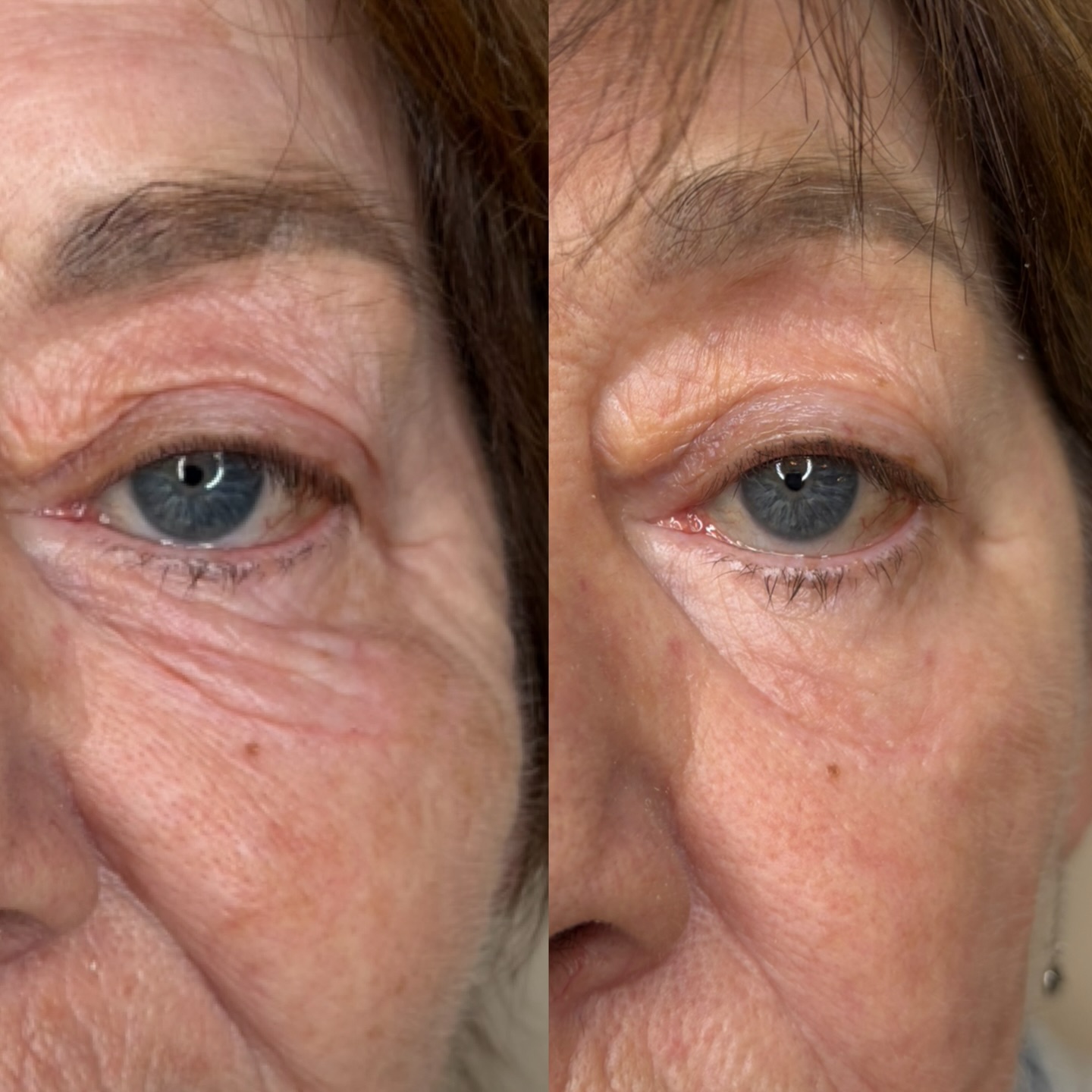 ✨ Avant / Après ✨
Blépharoplastie supérieure & inférieure
Laser UltraPulse – Lumenis
Résultat à 2 mois post-traitement