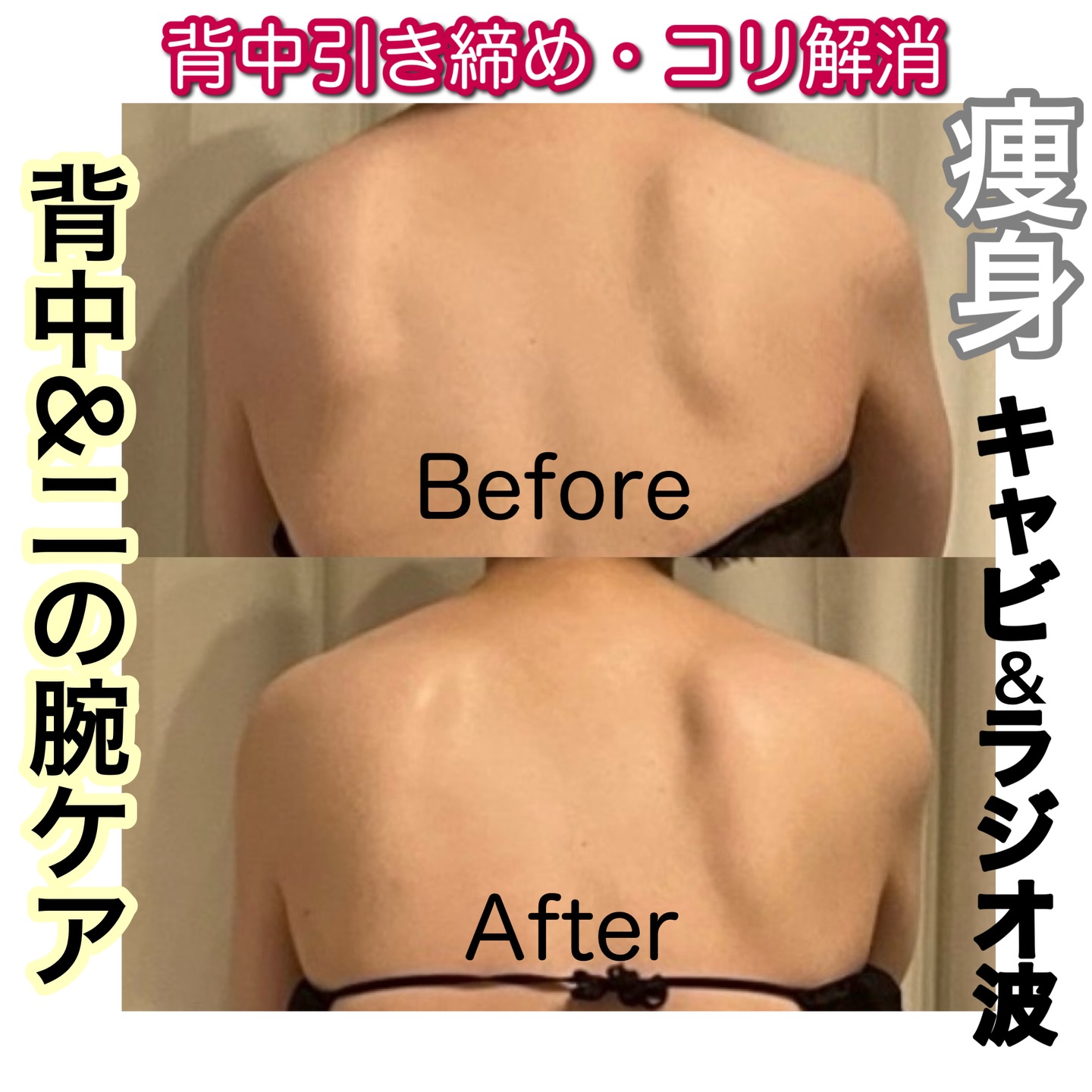 【背中&二の腕ケア】
肩の「もりっ」とした厚みがスッキリ✨
☑️肩の盛り感ダウン
☑️肩甲骨くっきり
☑️肩まわりが一回りコンパクトに!
キャビテーション+ラジオ波+痩身マッサージのしっかり3ステップでケアしていきます😌
⭐️より早く効果を出したい方に⭐️
↓↓↓↓↓↓↓↓
20分ガッツリ筋肉運動(EMS) ¥1,500
体をしっかり引き締めていきたい方や、運動が苦手な方にもオススメです!
寝てるだけなのに、20分後は筋トレ後の疲れと似てます😂
ぜひ一度ご体感ください♪
痩身/ダイエット/ぽっこりお腹/脚痩せ/お尻痩せ/二の腕/背中引き締め/キャビテーション/ラジオ波/痩身マッサージ/フェイシャル/小顔/たるみ/しみ/しわ/ヘッドマッサージ/眼精疲労/肩こり/首こり/ボディマッサージ/むくみ解消/血流促進/長居/あびこ/住吉/西田辺/都度払い