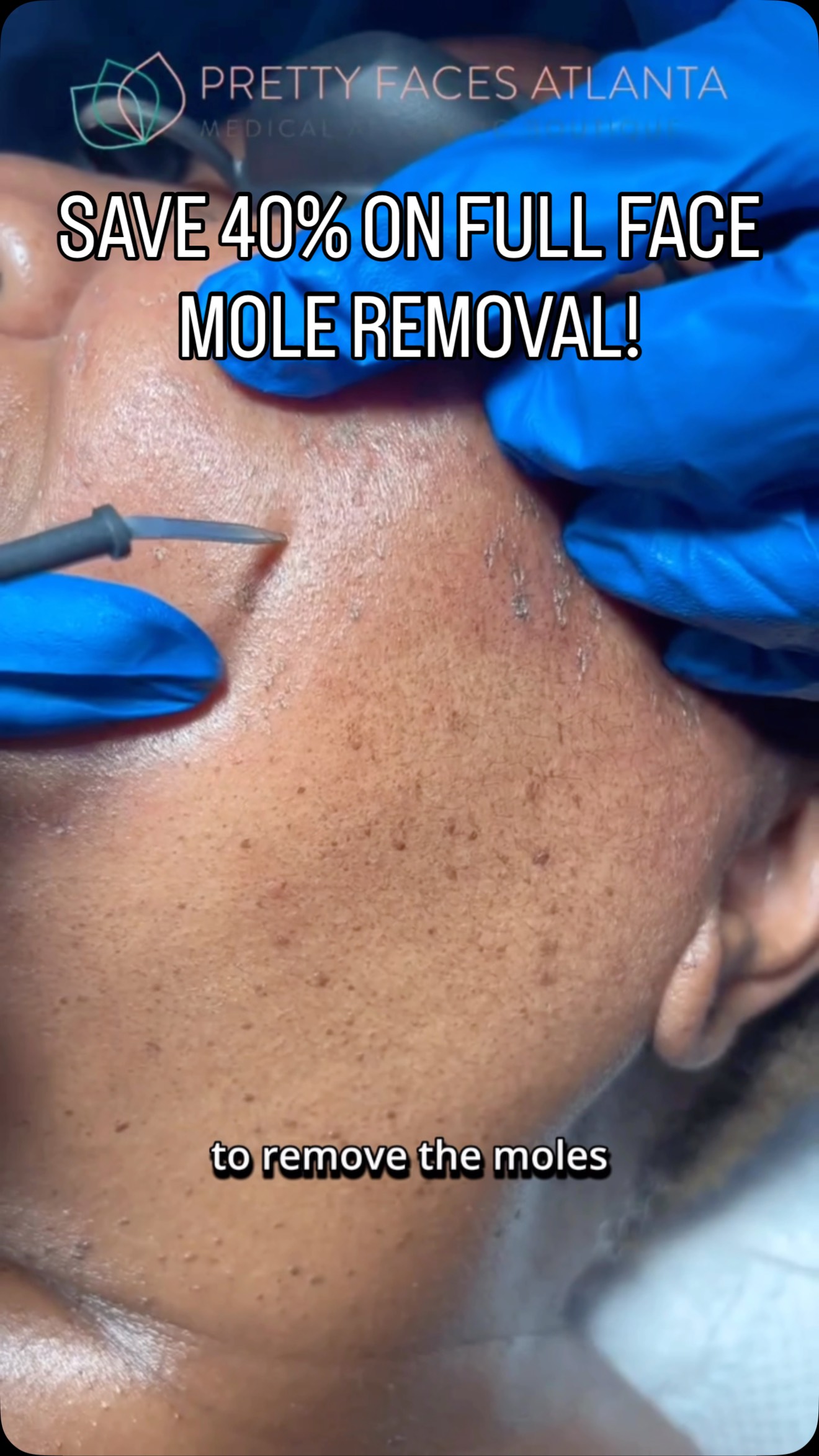 Ready for smooth, clear skin? 👀✨
Those moles you’ve been thinking about removing… this is your sign.
This month only enjoy 40% OFF full face mole removal and finally get the clean, even look you’ve been wanting 🙌🏽
✔️ Quick in office treatment
✔️ Minimal downtime
✔️ Boosted confidence instantly
✔️ Safe and precise technology
Stop covering it up. Stop editing it out. Let’s remove it 🤍
Appointments are limited and this special won’t last long. Secure your spot now and step into your most confident skin yet ✨
#MoleRemoval #ClearSkinJourney #AtlantaMedSpa #SkinConfidence #PrettyFacesAtlanta