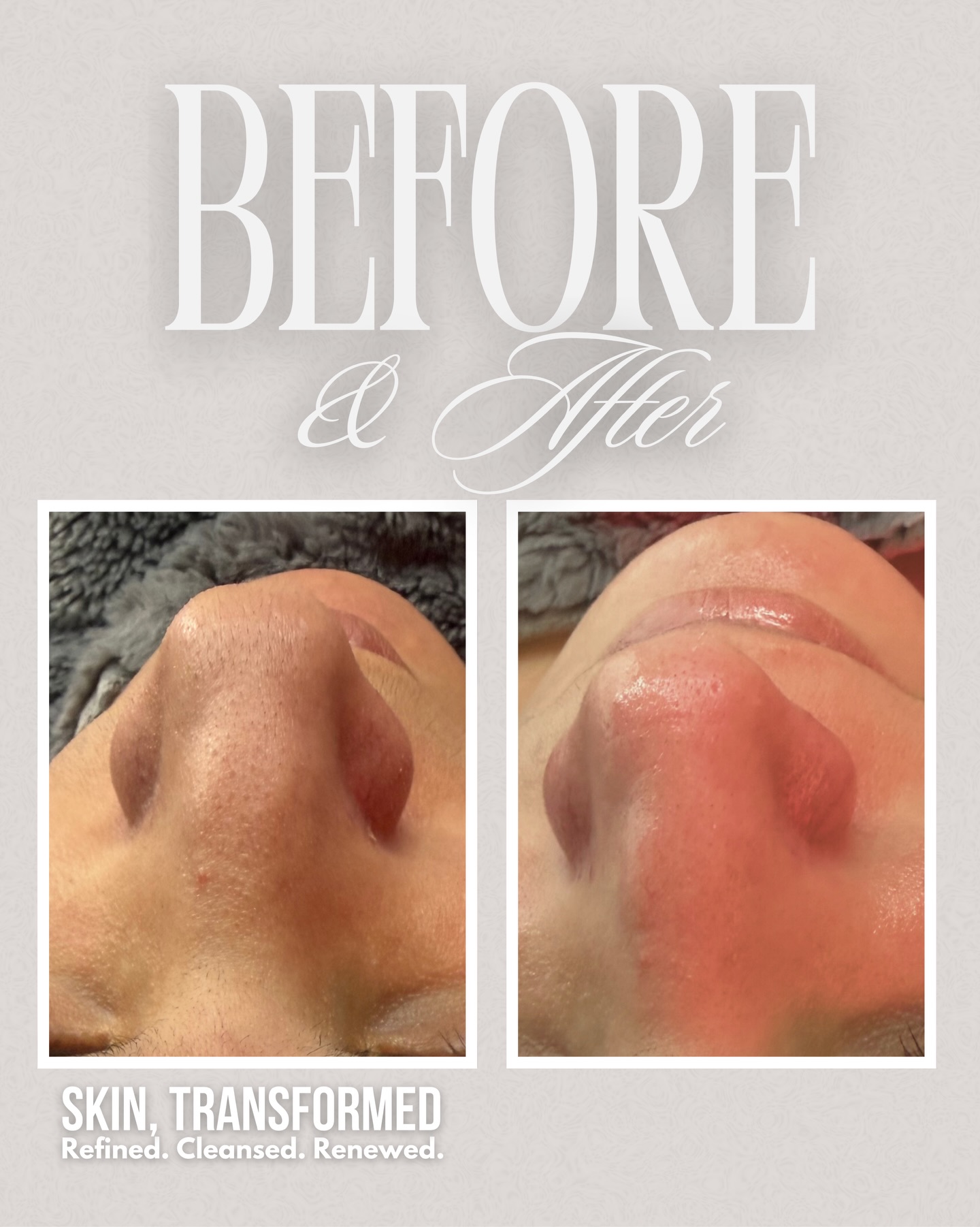 Clinical Facial Results in Jacksonville, FL
After a clinical facial treatment in Jacksonville, Florida, the treated skin shows visible improvement in clarity, texture, and overall radiance.
This professional facial treatment is designed to deeply cleanse and visibly enhance the appearance of the skin from the first session.
Visible Results in the Treated Area:
• Skin appears cleaner and clearer after deep pore cleansing.
• Texture feels smoother and more refined, helping improve the look of enlarged pores.
• Complexion looks brighter and more radiant.
• Hydration levels are visibly improved, leaving the skin plumper and balanced.
• Dullness and congestion appear reduced.
• The treated area looks more even-toned and refreshed.
This clinical facial in Jacksonville FL supports healthier-looking skin by improving visible smoothness, luminosity, and hydration in the treated area.
Ideal for individuals searching for:
• Deep cleansing facial in Jacksonville
• Professional facial treatment near me
• Skin texture improvement treatment
• Non-invasive facial rejuvenation
• Glow-enhancing facial in Jacksonville
The result is skin that looks clearer, smoother, and visibly renewed.