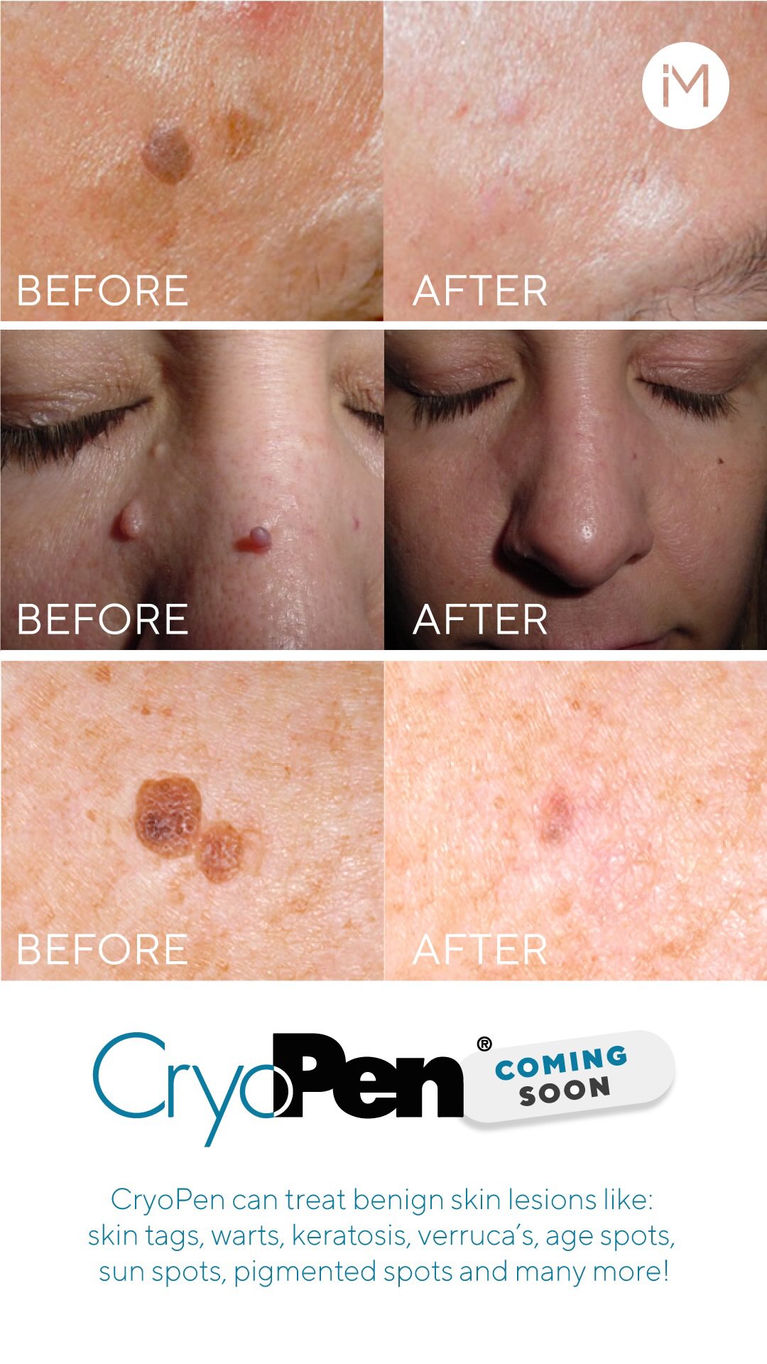✨ NEW CLINICAL TREATMENT AT VITAL ENERGY ✨
CryoPen Precision Cryotherapy — Introductory Launch
I’m delighted to introduce a brand‑new advanced treatment coming soon to the clinic: CryoPen Precision Cryotherapy — a highly accurate, fast and clinically trusted method for removing unwanted benign skin lesions with minimal discomfort and exceptional cosmetic results.
What CryoPen Can Treat
• Skin tags
• Warts
• Milia
• Cherry angiomas
• Seborrhoeic keratosis
• Pigmented lesions (suitable types)
• Sun spots / age spots
• Other small benign lesions assessed as safe for cryotherapy
Why Clients Love CryoPen
• Highly precise — targets only the lesion
• Fast — most procedures take seconds
• Minimal discomfort — a cold sensation rather than pain
• No downtime — return to normal activities straight away
• Excellent cosmetic outcomes
• Clinically trusted in dermatology and aesthetic medicine
Your Care, My Expertise
Every treatment includes a professional evaluation to ensure CryoPen is the right option for your specific lesion(s).
Complementary Consultation worth £45.00 ⭐️
Introductory Community Pricing DM FOR INFORMATION AND BOOKING #environskincare #cryopen #advanced #advancednutritionprogramme