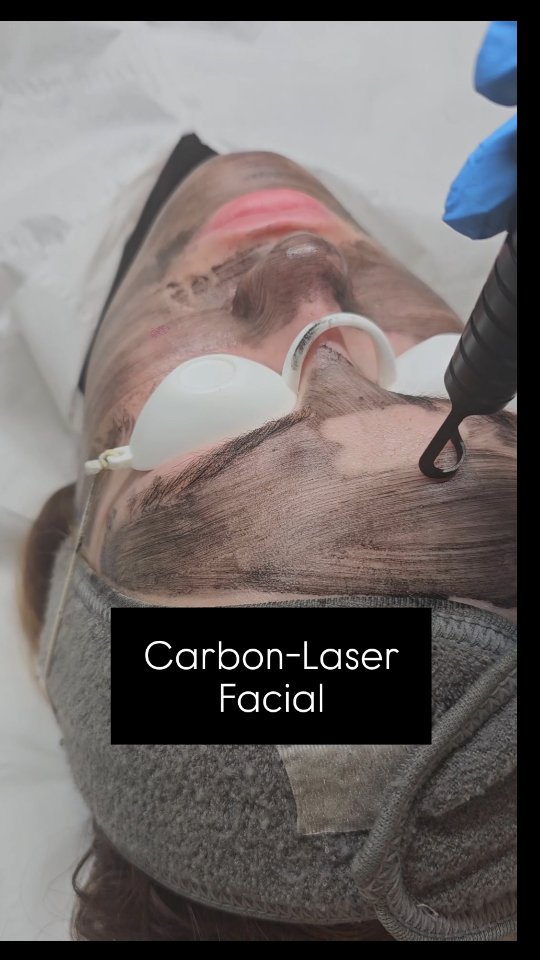 Carbon Laser Facial – The Ultimate Skin Reset
Our Carbon Laser Facial is a deep-cleansing, skin-refining treatment designed to brighten, smooth and refresh your complexion instantly.
A layer of medical-grade carbon is applied to the skin, penetrating deep into the pores.
We then use advanced laser technology to gently heat and shatter the carbon, removing impurities, excess oil and dead skin cells while stimulating collagen production.
Perfect for:
• Oily or congested skin
• Enlarged pores
• Acne-prone skin
• Dull or uneven tone
• Fine lines and texture
Expect tighter pores, a smoother texture and a radiant glow — with minimal downtime.
Safe, effective and suitable for most skin types following consultation.
#carbonlaserfacial #facials #essexfacial #basildonbeautytreatments #basildonfacials #essexlaserclinic