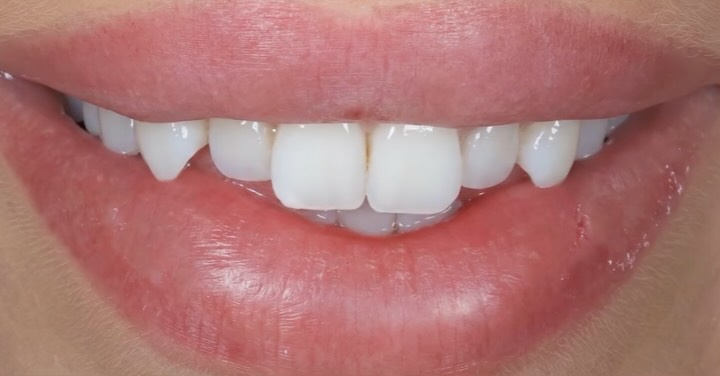 This patient wanted to improve the appearance of misalignment without aligners or aggressive treatment.
We carried out 8 free-hand composite veneers, with careful consideration of material shades and thicknesses to achieve an even, harmonious colour result across the smile without the composites looking thick from the front!
No drilling was necessary!
Swipe to see the before and after ➡️
#CompositeBonding #NaturalSmile #SmileMakeover #CosmeticDentistry #BeforeAndAfter
