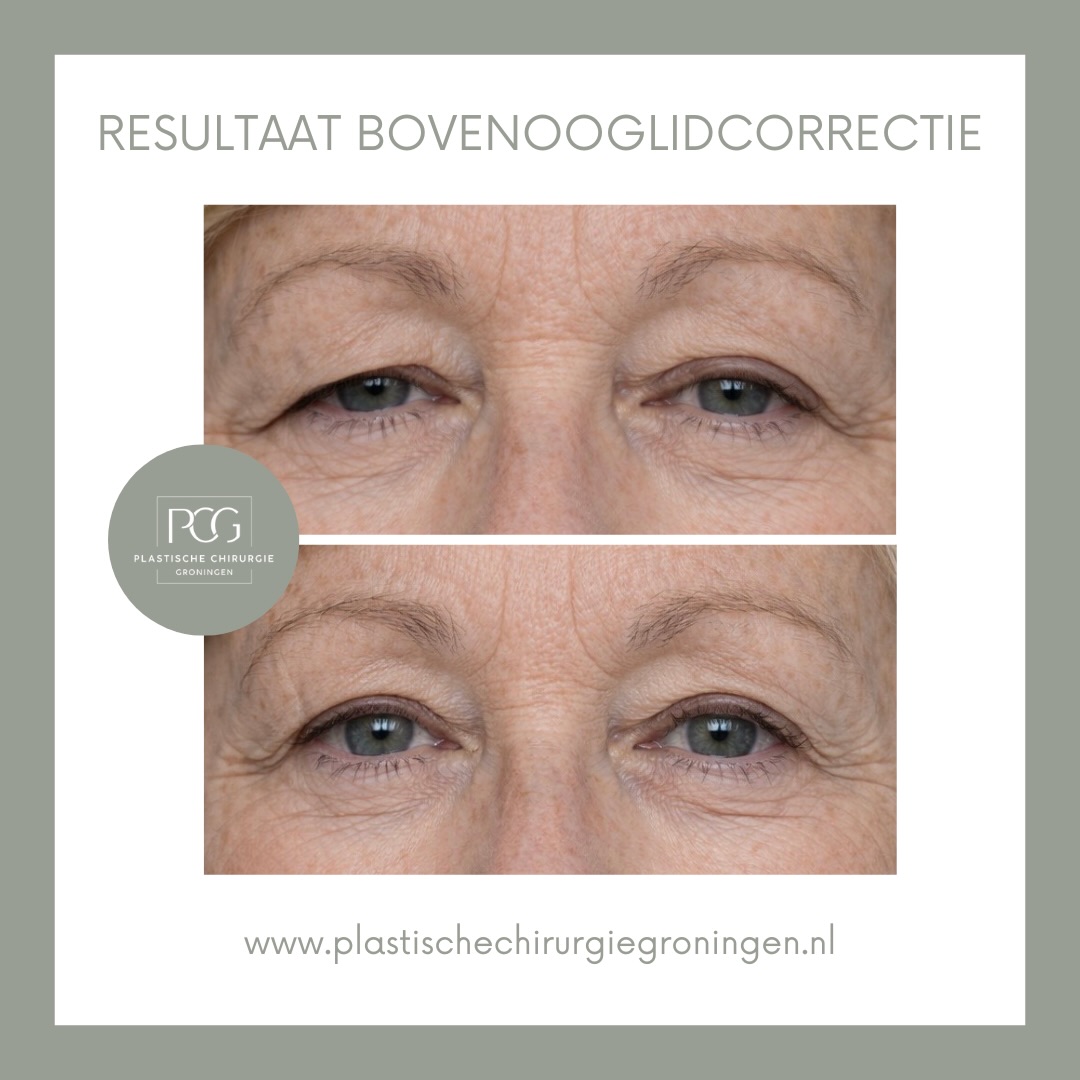 Een prachtig resultaat van een bovenooglidcorrectie 🤍✨
Foto 1: Voor de operatie.
Foto 2: Zes weken na de operatie.
Overweegt u ook een ooglidcorrectie of wilt u graag meer informatie? Neem dan gerust contact met ons op!
📞: 050 - 211 04 96
💌: info@pcgroningen.nl