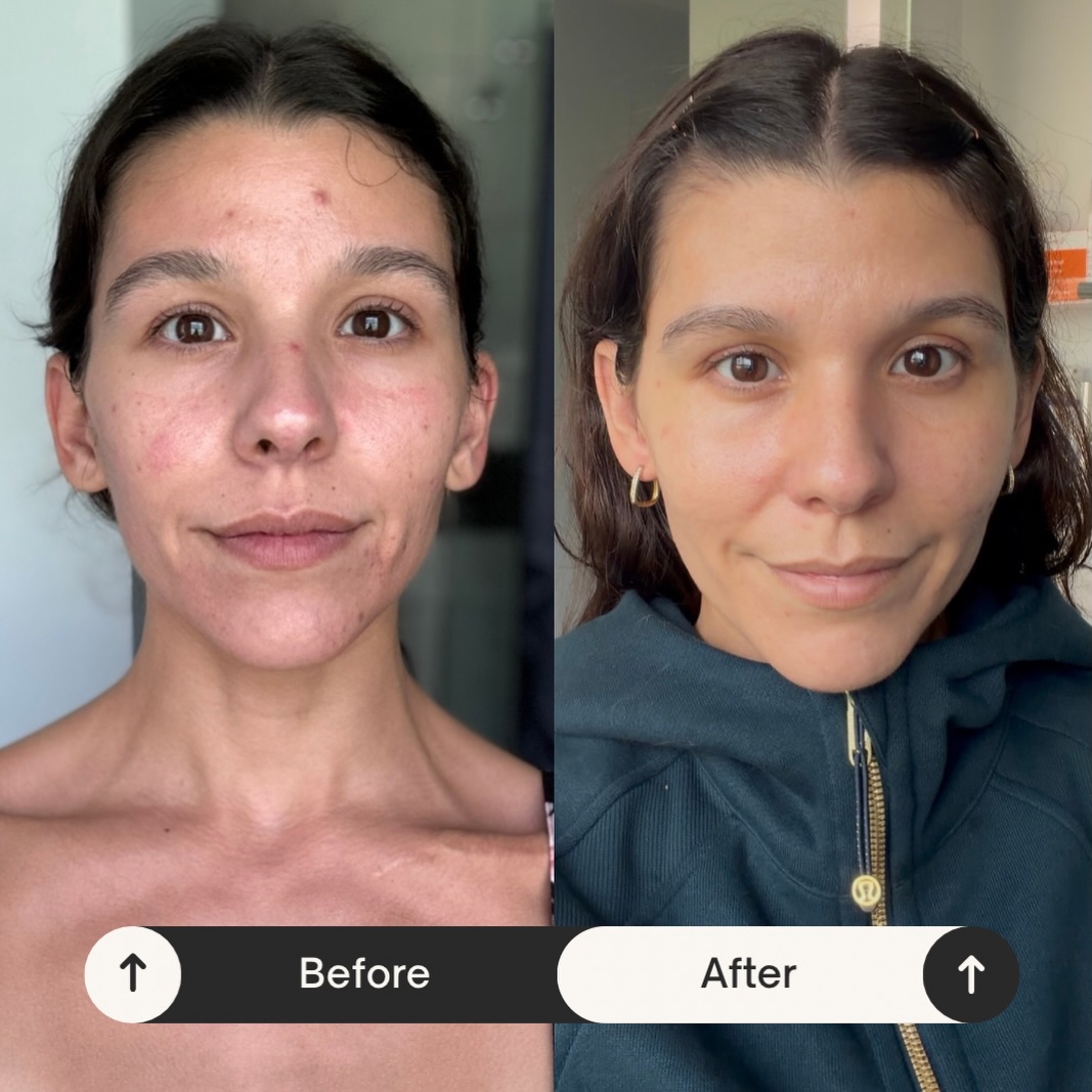 Skin, refined. 🤎
Three microneedling sessions and the difference speaks for itself. Smoother texture, softened redness, and that natural, healthy glow.
Consistency is where the magic happens. 🌟
Don’t forget - our Microneedling Membership is launching MARCH 1ST(!!!)
#ocalamicroneedling #ocalamedspa #beyondskinandwellness #microneedling #beforeandafter