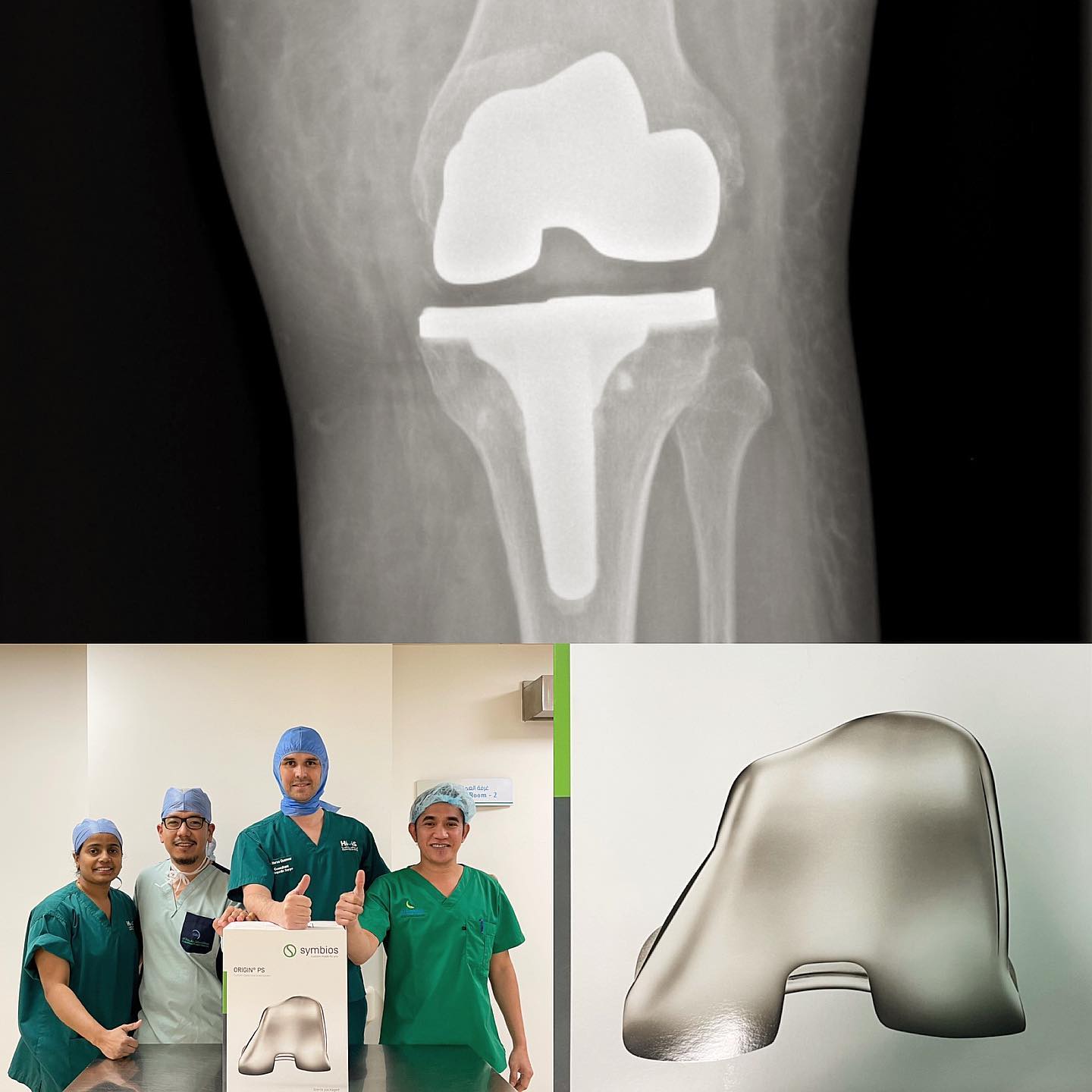 Great Job from the best Ortho Team in Dubai @hmsgarhoudhospital to offer the best for our patients #custommade #totalkneereplacement #santigroup #orthopaedic