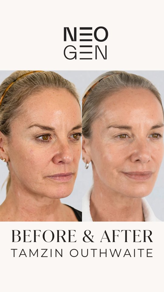 These before and afters of Tamzin Outhwaite speak for themselves! 😍 If you’ve been looking for a sign to refresh your look, this is it.
We are so inspired by these incredible results from Dr. Maryam McMillan at Ambra Clinic. They are the perfect example of why we are so proud to offer NeoGen technology right here at The Courtyard.
What makes NeoGen different? It doesn’t just treat the surface; it works deep within the dermis to stimulate your own natural collagen and elastin. This means your skin actually becomes healthier and more resilient over time.
Tamzin’s radiant glow is proof that you don’t need surgery to see a massive difference!
Ready for your own transformation?
DM us or click the link in our bio to book your FREE consultation today!
#neogen #skinrejuvination #neogenplasma #transformation #boostcollagen