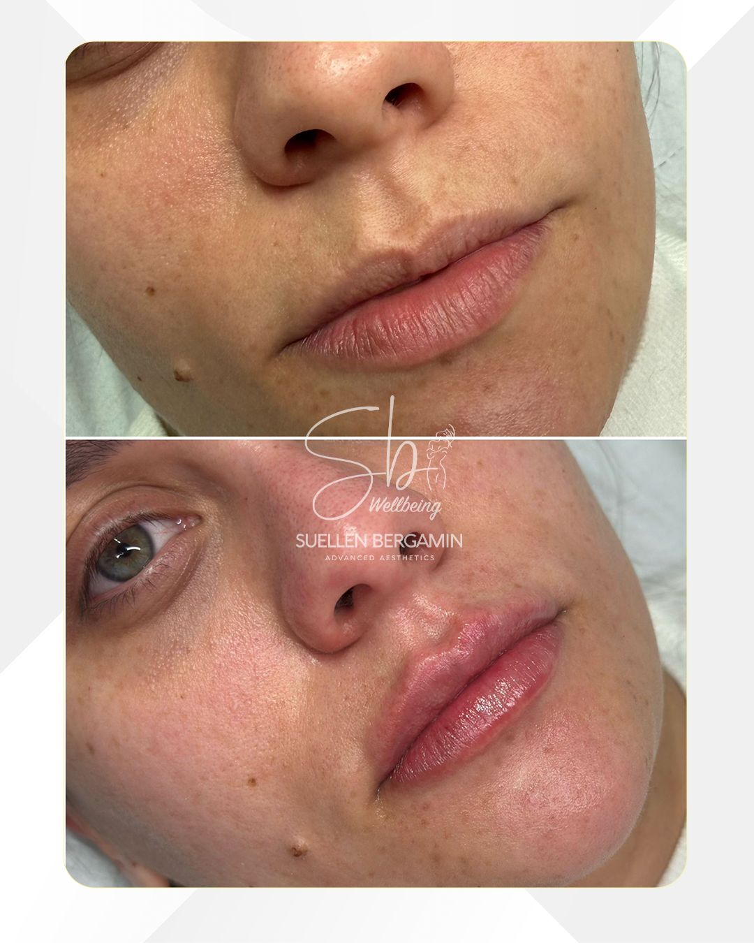 Eu costumo dizer que o preenchimento labial tem muito mais a ver com autoestima do que com volume somente...
Quando os lábios ganham contorno, hidratação e proporção, o rosto fica mais harmonioso e a confiança aparece na hora!!
Muitas mulheres não querem exagero.
💖 Querem se sentir seguras.
💖 Querem voltar a usar batom com prazer.
💖 Querem sorrir sem pensar duas vezes.
Resultado bonito é aquele que valoriza você, em vez de mudar quem você é.
📲 +44 7398 192413
.
I usually say that lip filler has much more to do with self-esteem than just volume alone…
When the lips gain contour, hydration, and proportion, the face becomes more harmonious — and confidence shows instantly!!
Many women don’t want exaggeration.
💖 They want to feel secure.
💖 They want to enjoy wearing lipstick again.
💖 They want to smile without thinking twice.
A beautiful result is one that enhances who you are, rather than changing you.
📲 +44 7398 192413