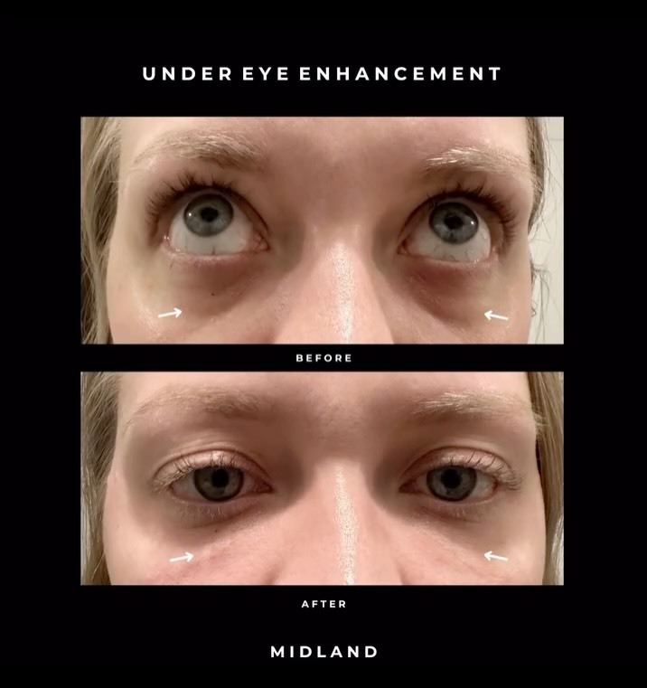 ✨ Under Eye Rejuvenation ✨
This lovely client was treated with 1mL of Teoxane Redensity 2 to address:
▫️ Darkness under the eyes
▫️ Eye bag appearance
▫️ Tired-looking eyes
⏱ Treatment time: 20–30 minutes
💉 Technique: Under eye dermal filler using a cannula approach for minimal bruising
📆 Results: Last up to 12+ months (a tweak/top-up may be required, sometimes up to 2 sessions)
A subtle yet significant refresh — restoring brightness and leaving the under-eye area looking smoother, fresher and beautifully rejuvenated 🤍
#UnderEyeFiller #TearTrough #Teoxane #AestheticResults #MidlandClinic