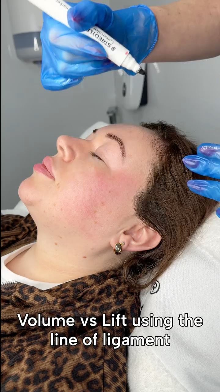 Most injectors chase the cheekbone.
Advanced injectors understand the retaining ligaments.
The line of ligament determines:
✔️ Where lift is created
✔️ Where product should not migrate
✔️ How we restore youthful midface projection
Respecting anatomical boundaries prevents heaviness, lateral spread, and unnatural fullness.
Cheek filler done correctly should create lift — not weight.
Train smarter. Inject safer.
#AestheticTraining #aestheticsliverpool #CheekAugmentation #AnatomyMatters #MedicalInjector