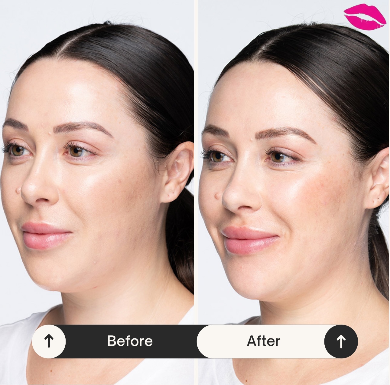 Your lips… just better. ✨
Soft, natural-looking results by Dr. Dupon — $495 per syringe
📞 Call now to book your appointment .