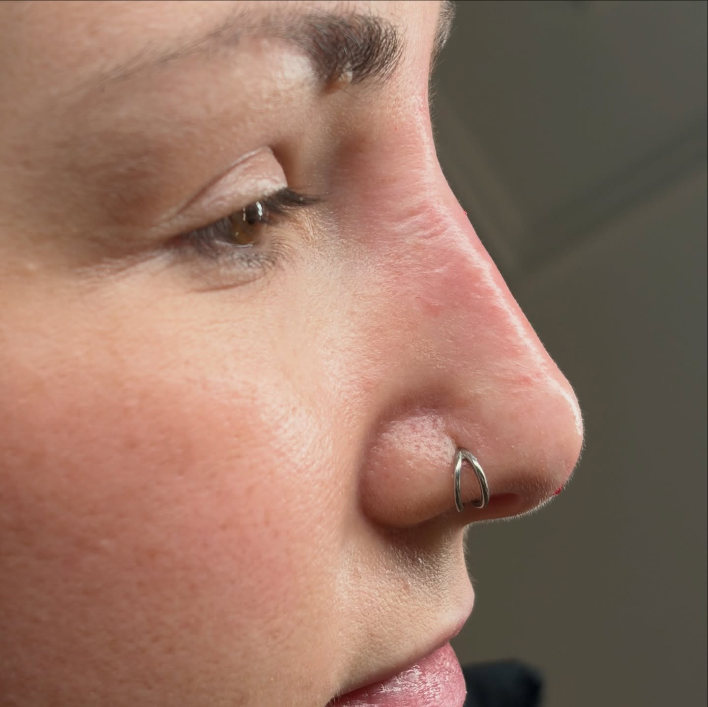Most people think nose filler makes the nose smaller.
It doesn’t.
It creates balance.
In this case, strategic placement along the bridge and tip was used to smooth the profile and improve projection — without adding unnecessary volume.
Non-surgical rhinoplasty is one of the most technically demanding injectable treatments.
The nose is highly vascular, which means depth, angle, product choice and anatomical understanding are everything.
Immediate results.
No surgery.
Minimal downtime.
For those who want subtle structural improvement without going under the knife.
Consultations required.
DM NOSE to enquire 🤍