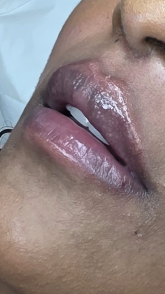 1ml Red Lips ❤️ 😍
.
Lip enhancement
#redlips #lipplump #pinklips #unevenlips