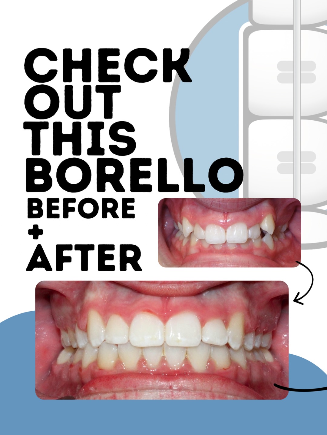 Every smile transformation has a starting point- this was Joey’s! Swipe to see more! 🤩😁
See the link in our bio to schedule a free smile consultation today!