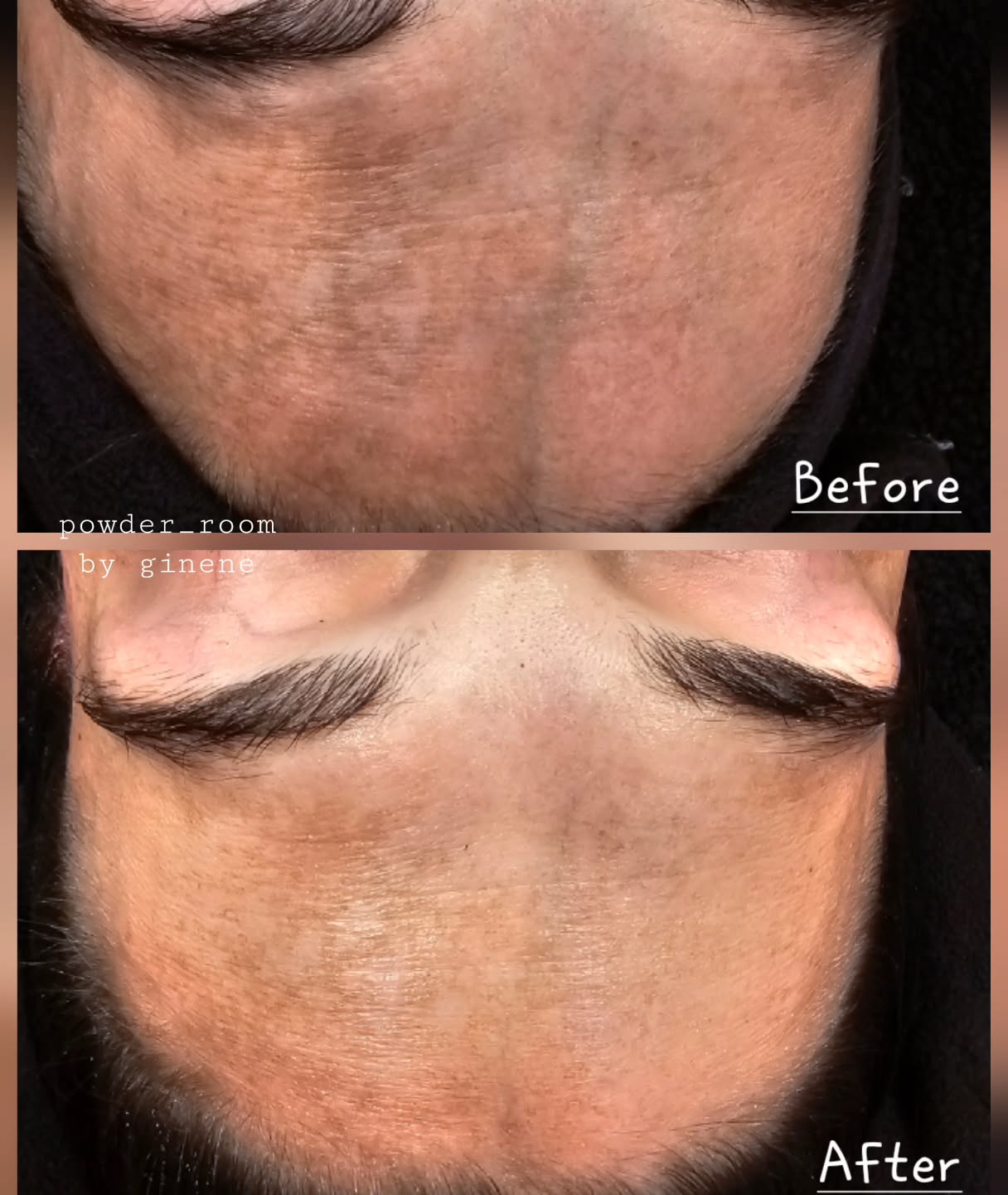 Before and immediately after her first facial using my LED4 MEDICAL GRADE LED MACHINE.
I use LED in nearly all of my facial treatments. I find it gives so much more to the skin when combined with peels, needling (before), ipl skin rejuvenation, HIFU. Or just for deep relaxation.
Also by introducing LED your clients can then get a feel of how amazing light therapy is and will want THE MASK 👌 to get these benefits daily!!