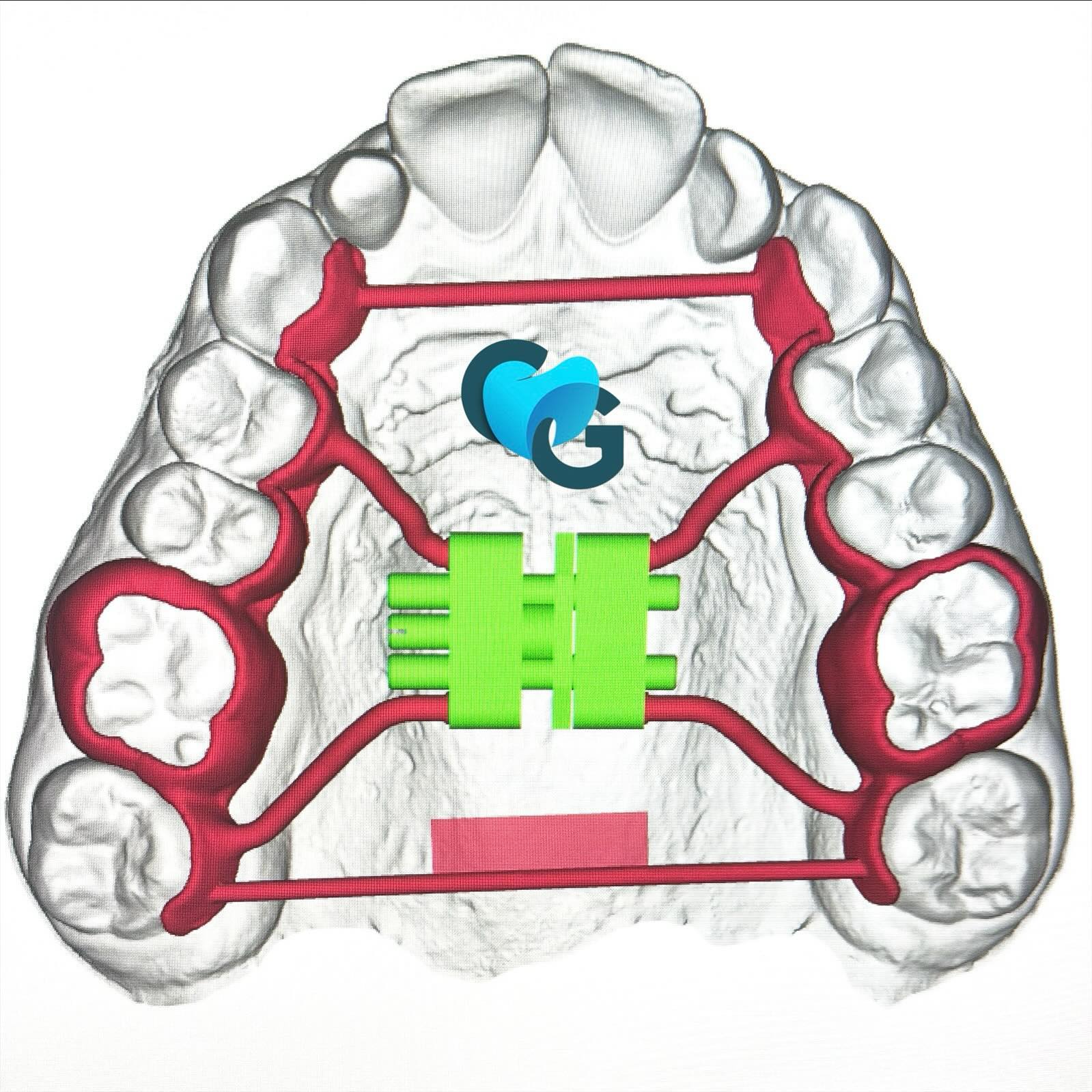 #disjoncteur #numerique #baguesanatomiques #leafexpander #appareildentaire #ortho #orthodontie