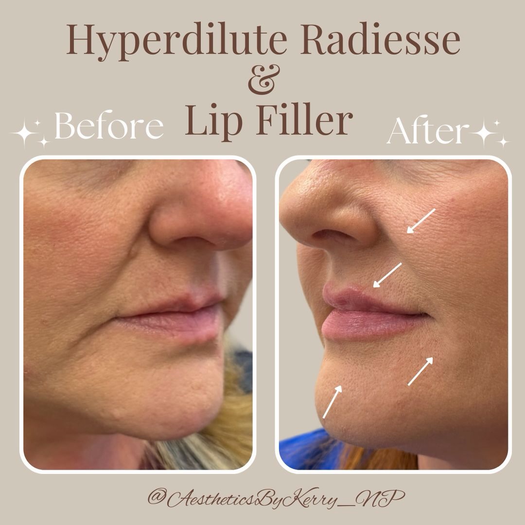 Hyperdilute Radiesse + subtle lip enhancement can do more than add volume — it can restore structure, support collagen, and refine the entire lower face.
In this transformation, we focused on improving skin quality, softening lines, and enhancing balance rather than overfilling. Thoughtful placement makes all the difference.
A refreshed look doesn’t come from chasing trends — it comes from strategic, customized treatment planning.
📍 Book a consultation to explore what regenerative filler treatments could look like for you.
.
.
.
#clientspotlight #biostimulator #lipfillers #antiagingtreatment
