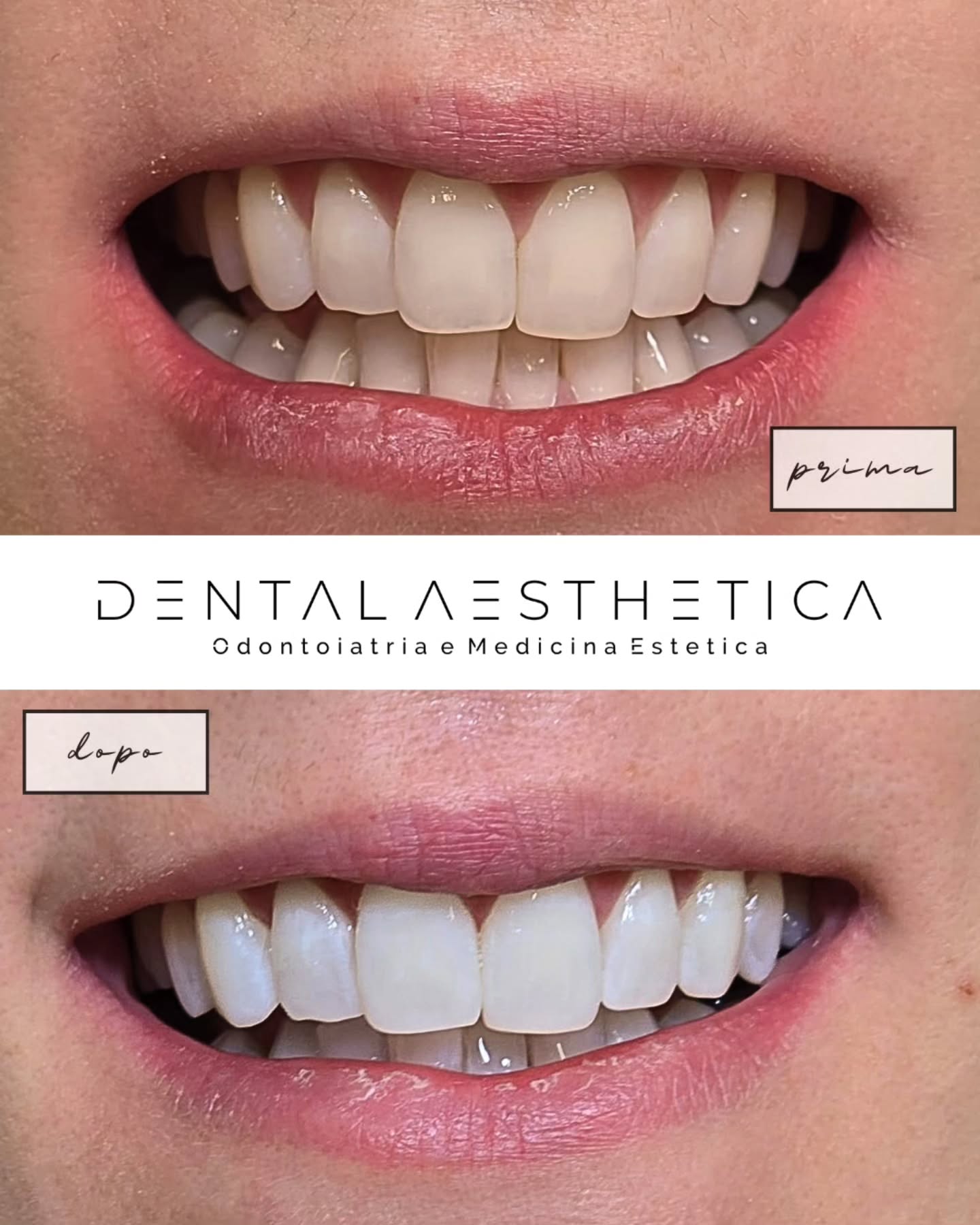 Sbiancamento dentale professionale. 🦷✨️
Sorriso più bianco e splendente, in soli 14 giorni.
Dental Aesthetica - Odontoiatria e Medicina Estetica
📍 viale della Grande Muraglia 256, zona EUR-Torrino
📱 375 88 47 069