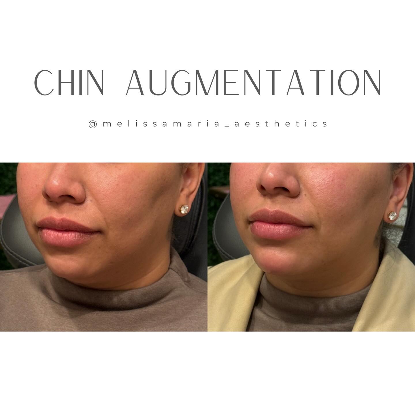 Chin augmentation is tricky and it’s very tricky for it to look this natural. Could we 1-2 syringes and just add the projection she needs? Of course but that would leave her with a stiletto chin that looks like it was attached and not part of her natural jawline.
You can see in the before that she had some shadowing above her chin to begin with and had some indentation beside her chin that we started to see worsen as we started to project her chin.
This meant that we had to take a break from the projection and use a softer stretchier filler to soften the shadows and a thicker filler to connect her chin to her jawline.
All in all we used 3 syringes for this result. 1 to project her chin and improve her profile, one to soften the chin shadowing and another to attach it to the rest of her jawline.
The result: extension of her chin that looks like she was born with it. It’s not a separated chin that looks like it was stuck on!
Swipe to the second photo to see the improvement in her jawline out lined!