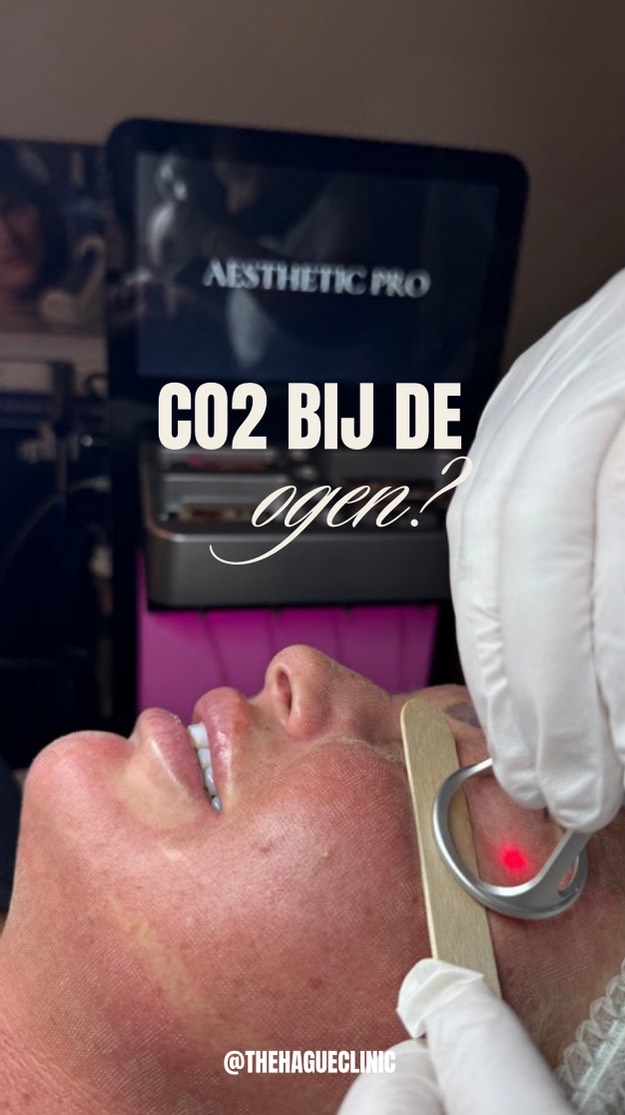 CO2 onder de ogen is echt een game-changer voor lijntjes, rimpels, donkere kringen én kraaienpoten 😍
#co2laserbehandeling #co2behandeling #thehagueclinic #huidkliniekdenhaag