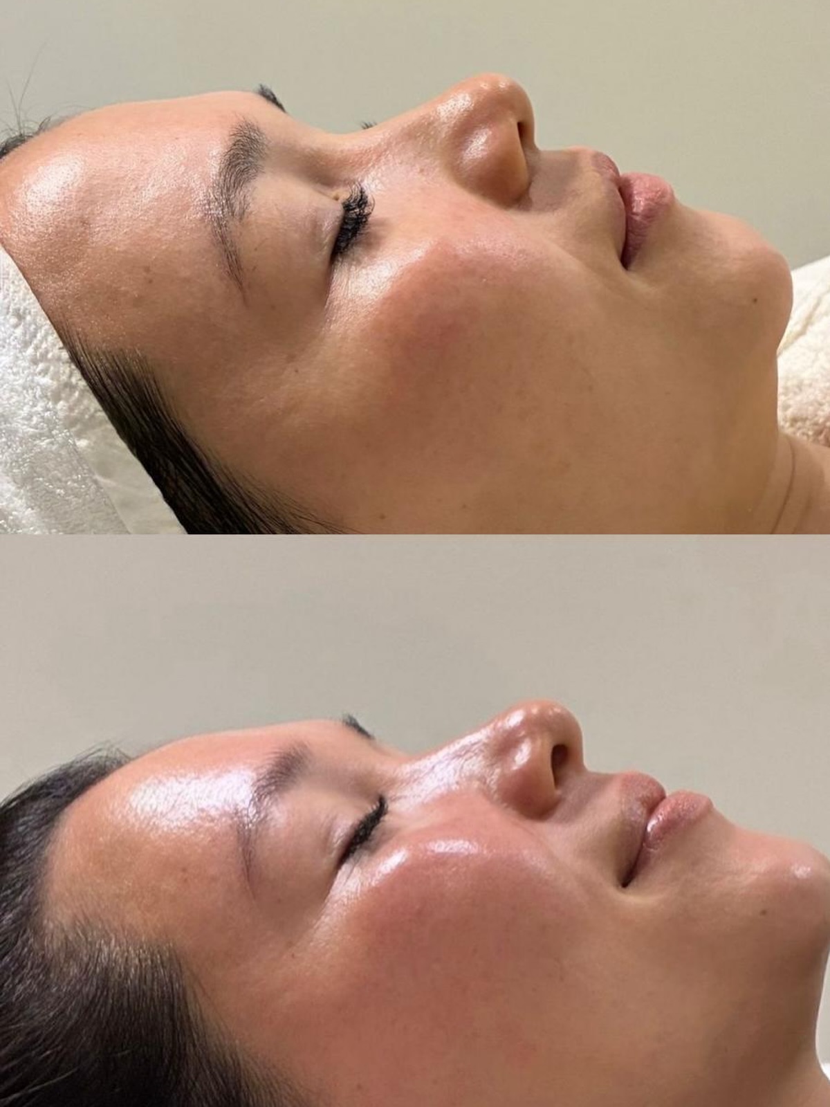 Wanting a glow like this???
As we say goodbye to Summer, we welcome the cooler months with a peel package for you!
Buy a pack of 3 peels and receive 4 FREE Aspect Dr skin products to get you onto the journey of better looking skin.
Products include
• Cleanser
• Exfol A Plus
• Vitamin C
• Resveratrol Moisturiser
The Aspect Peels smooths, refines & refreshes—Perfect for all skin types, especially dull or dehydrated.
Time: 30mins
Price : $360
Treatment plan: 1 peel every 4 weeks
Suitable: All skin types
Location: Bare Beauty Aesthetics Clinic, Bulimba
To book head to our website (link in bio)
Alternatively send us a message or comment on this post and we will get you booked in.
#medicalgradeskincare #peels #aspectdr #skincare #barebeautybrisbane