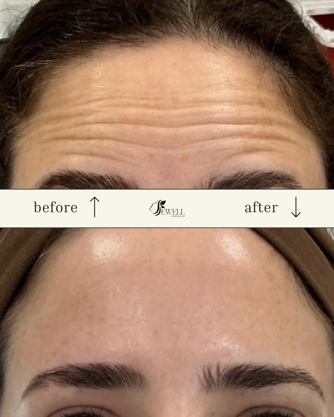 Bye wrinkles, hello confidence! 💉✨
Call or text today to book your appointment!
☎️ 239-448-3383
📩 chris.jewell@jewellmedicalspa.com
🌐 www.jewellmedicalspa.com | www.mrinjectable.com
📍 1044 Castello Drive, Ste 213 Naples Florida 34103
💳 We Accept Care Credit!
*
*
*
#botox #botoxinjections #botoxbeforeandafters #foreheadbotox #botulinumtoxin #injectables #cosmeticinjectables #aesthetics #beauty #naplesbeauty #naplesinjector #medspa #bestaestheticinjectors #beforeandafter