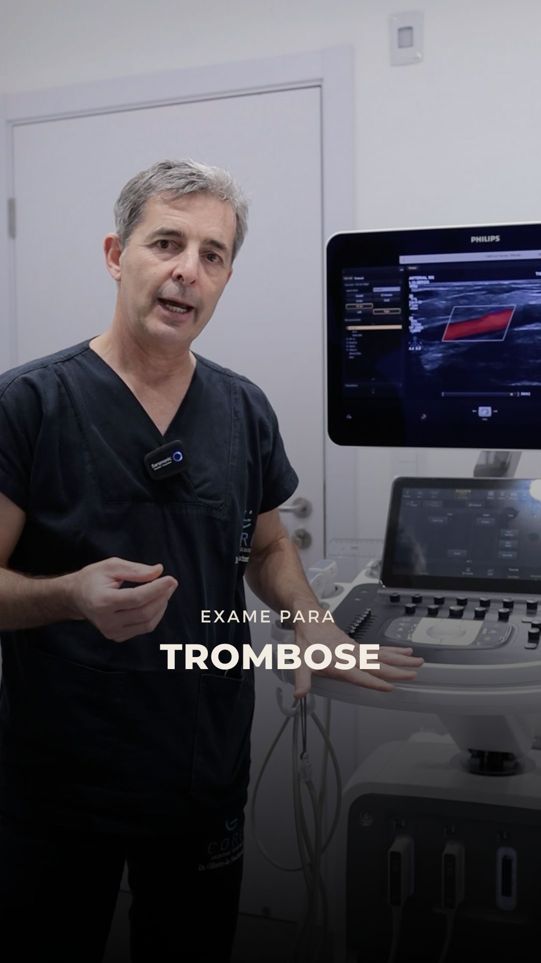 Trombose é uma palavra que assusta. E com razão.
Dor na perna, inchaço repentino, sensação de peso… é comum que o paciente procure um pronto atendimento com medo de estar diante de uma trombose.
Mas é importante entender: nem toda dor na perna é trombose. E nem todo serviço de emergência está preparado para confirmar esse diagnóstico com precisão.
O diagnóstico começa com uma boa anamnese, uma história clínica detalhada e um exame físico cuidadoso.
E o exame considerado padrão-ouro para confirmar ou afastar trombose venosa nos membros inferiores é o ecodoppler venoso.
Existem outros exames, como a angiotomografia, mas na maioria dos casos ela é desnecessária. O ultrassom com Doppler é o método mais adequado, seguro e eficaz para essa investigação.
Na Coris, não funcionamos em regime de plantão 24 horas, mas conseguimos oferecer acesso rápido ao ecodoppler, inclusive em situações urgentes. É comum recebermos encaminhamentos de colegas que não conseguiram realizar o exame na emergência e precisam de agilidade para fechar ou descartar o diagnóstico.
No próximo vídeo, vamos explicar melhor o que é, de fato, a trombose venosa e quando você deve se preocupar.