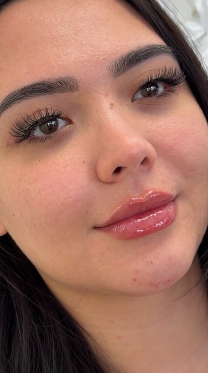 Subtle volume. Balanced shape. Kissable lips. 🤎
Lip enhancement…the Locococo way ✨
Strategic placement in the lips, chin, and pyriform to create harmony, projection, and soft facial balance. No overfilling. No guessing. Just intentional artistry.
Balanced > big.
Refined > obvious.
#locococoaesthetix #locococo #hawaiiinjector #lipinjections #hnl