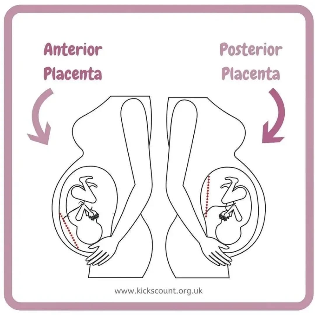 .
π Anterior Placenta π
I had an anterior placenta with both my babies, it can sometimes mean that it's harder to feel those kicks as the placenta has a cushioning effect! I was concerned about reduced movement once with my eldest and didn't hesitate to head straight to #princessannehospital to get checked out (all was well)
With my youngest, my little lady literally kept me on the verge of heading in on so many occasions...then she would move and start kicking like a horse π
Do not hesitate to get checked if you're worried, you're not wasting anyone's time. Anyone else had an anterior placenta?
Reposted @kicks.count Have you got an anterior placenta?
An anterior placenta simply means your placenta is attached to the front wall of your uterus, between the baby and your tummy. It's a completely normal place for it to implant and develop.
Learn more: www.kickscount.org.uk/anterior-placenta
#anteriorplacenta #kickscount #heavenlyhypnobirthing #hypnobirthingclasses