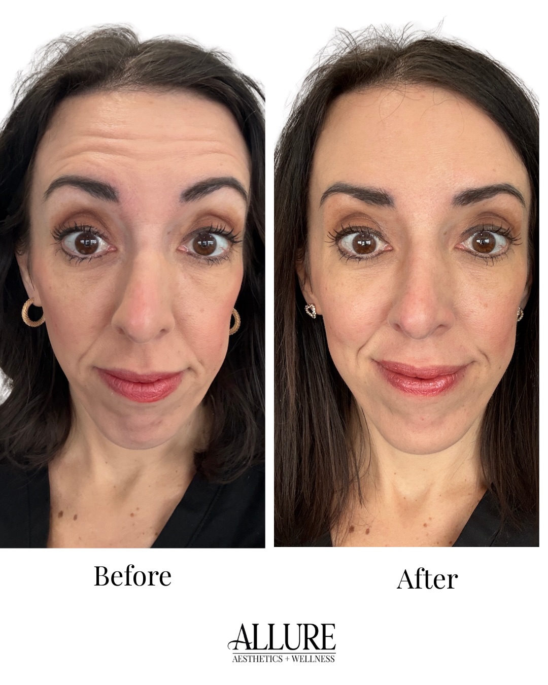 šš»It's me! Just a refreshed, relaxed version!
.
I don't share before and afters of my patients very often, (or ever) so you're stuck with seeing my results! These are no filter photos.
.
Botox was used for this treatment, done by the best injector I know š
.
1. Forehead lines relaxed
2. Goodbye 11's
3. Improved skin quality, subtle lip flip for top lip
4. Crow's feet softened
5. DAO's and mentalis (chin)- no more RBF!
.
Effortless results start with precision, book your complimentary consultation today!
.
āļøBOOK WITH ME āļø
š»www.allureaw.com
š 563-258-4698
.
āļø FOLLOW ME āļø
Nicole Powers, ARNP, AGNP-BC
@nicolepowers_np
Allure Aesthetics + Wellness
@allure_iowa
.
#nurseinjector #botox #nursepractitioner